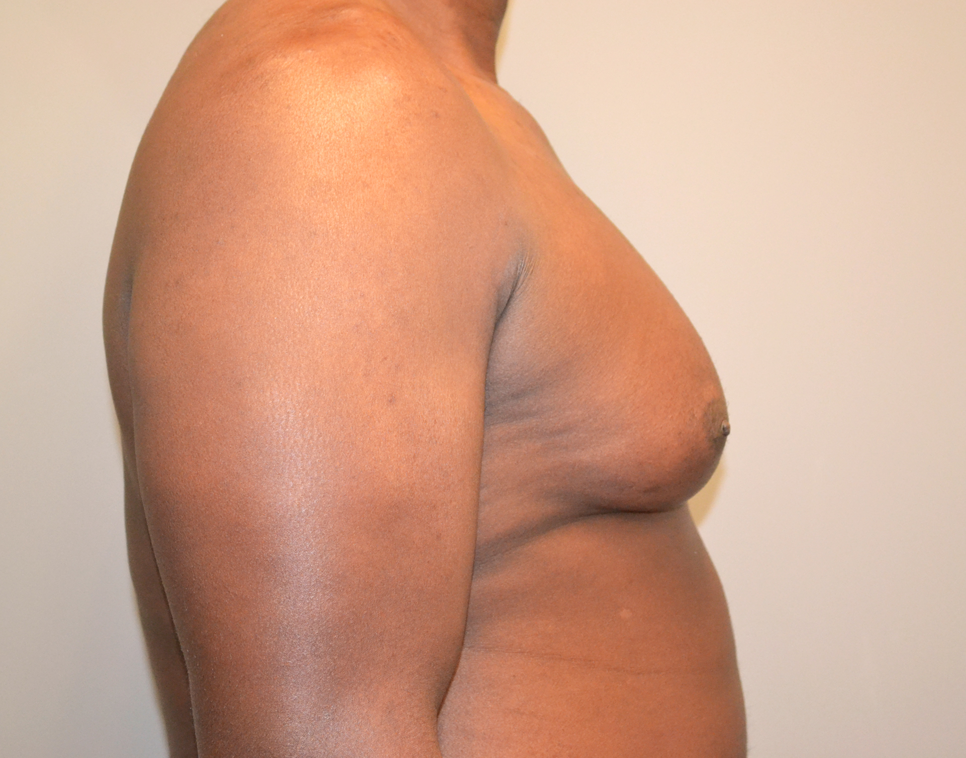 Gynecomastia Before & After Case 19