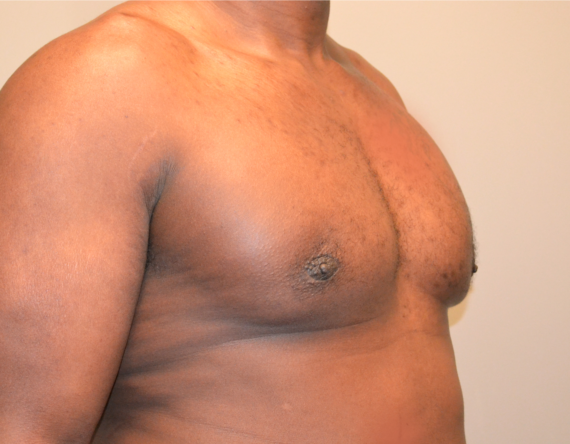 Gynecomastia Before & After Case 19