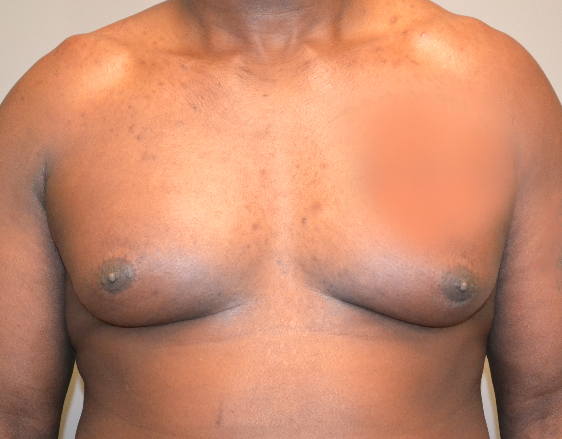 20 Gyno b1