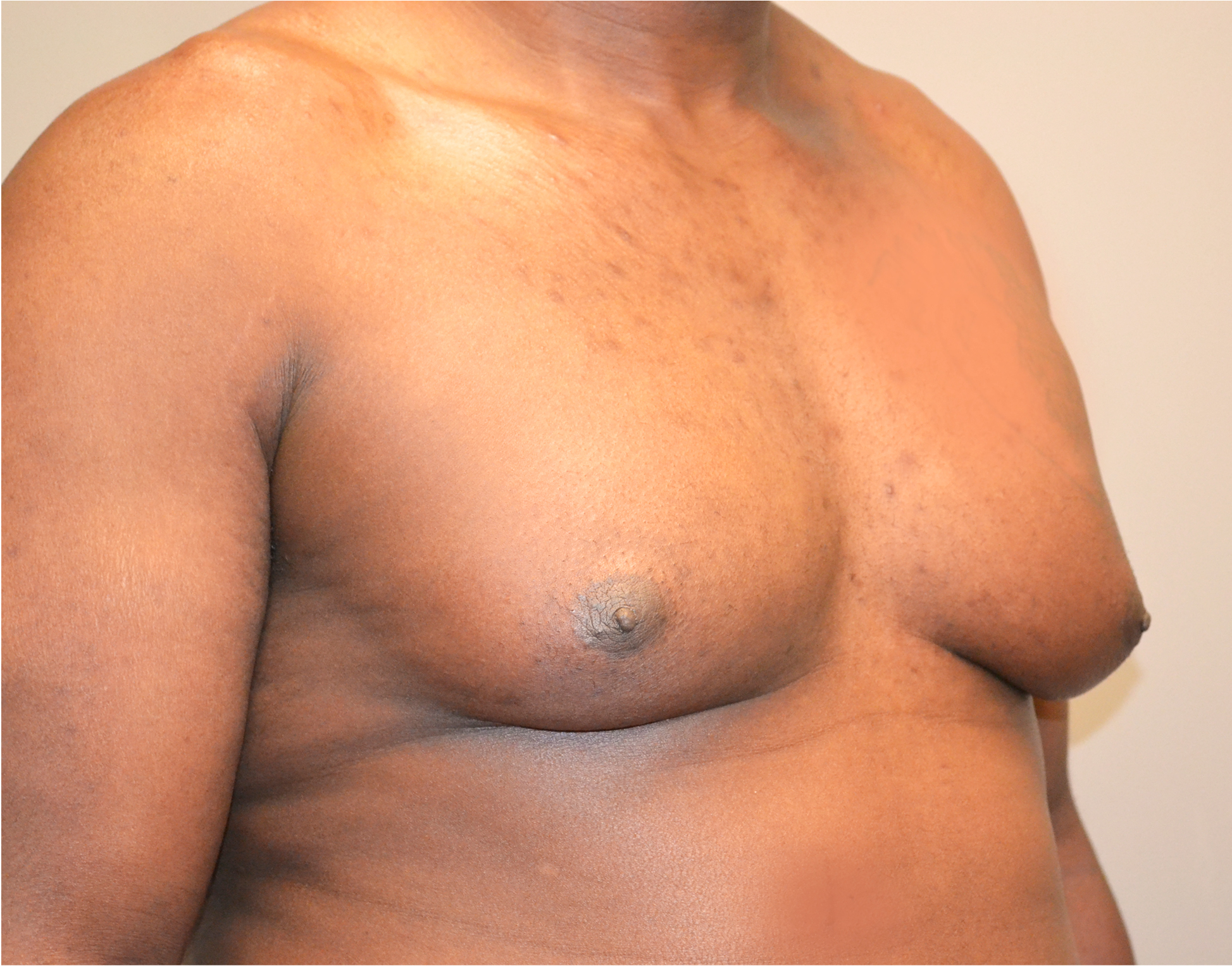 Gynecomastia Before & After Case 19