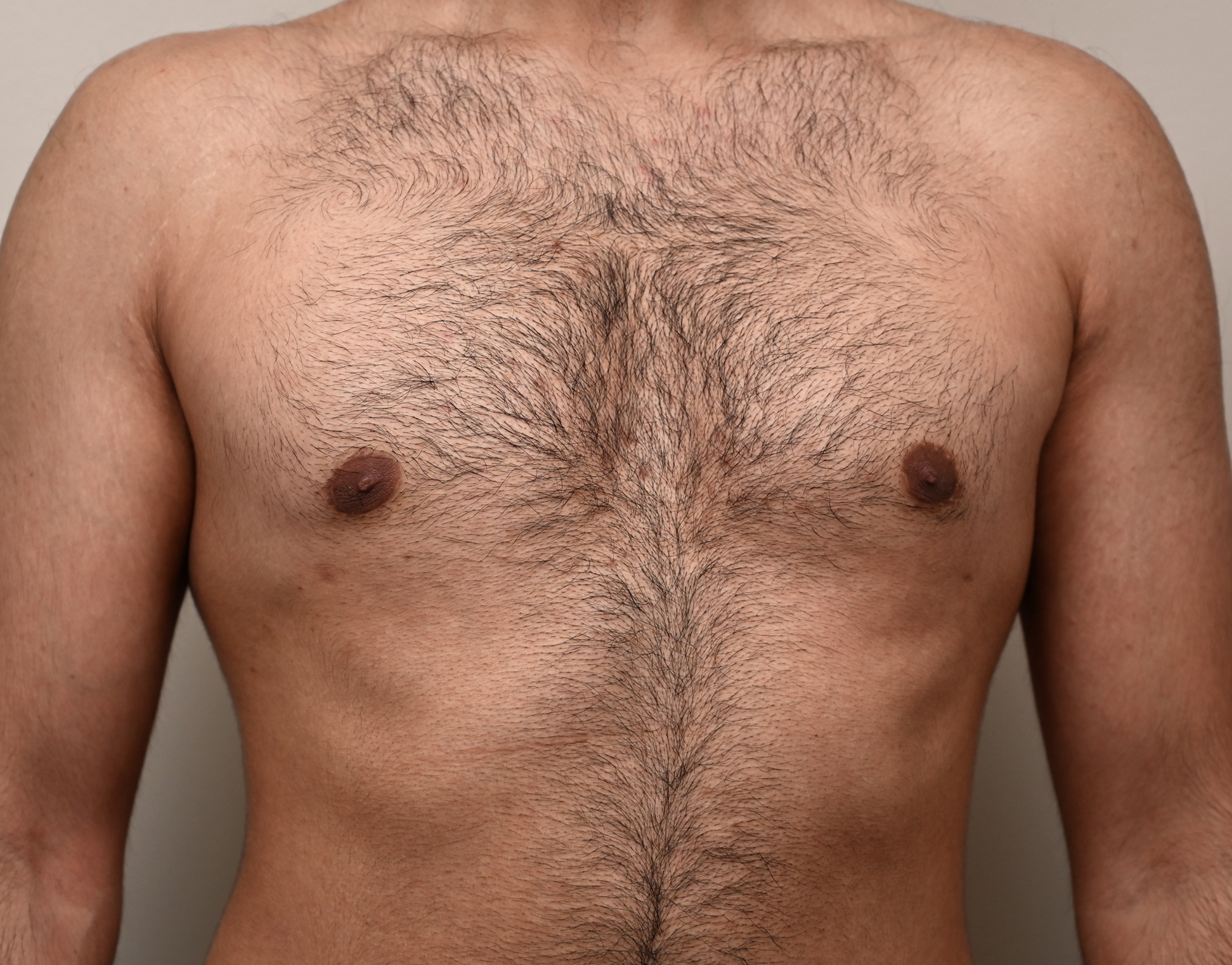 Gynecomastia Before & After Case 20