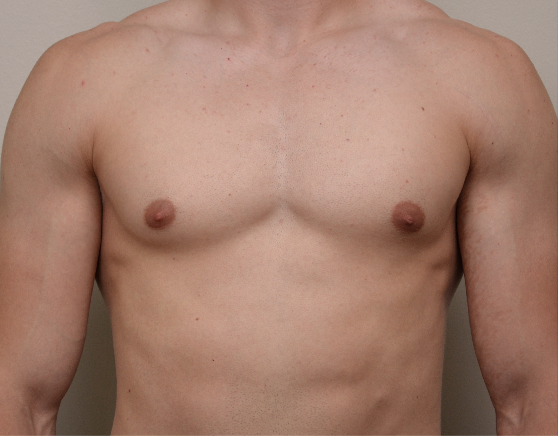 22 Gyno b1