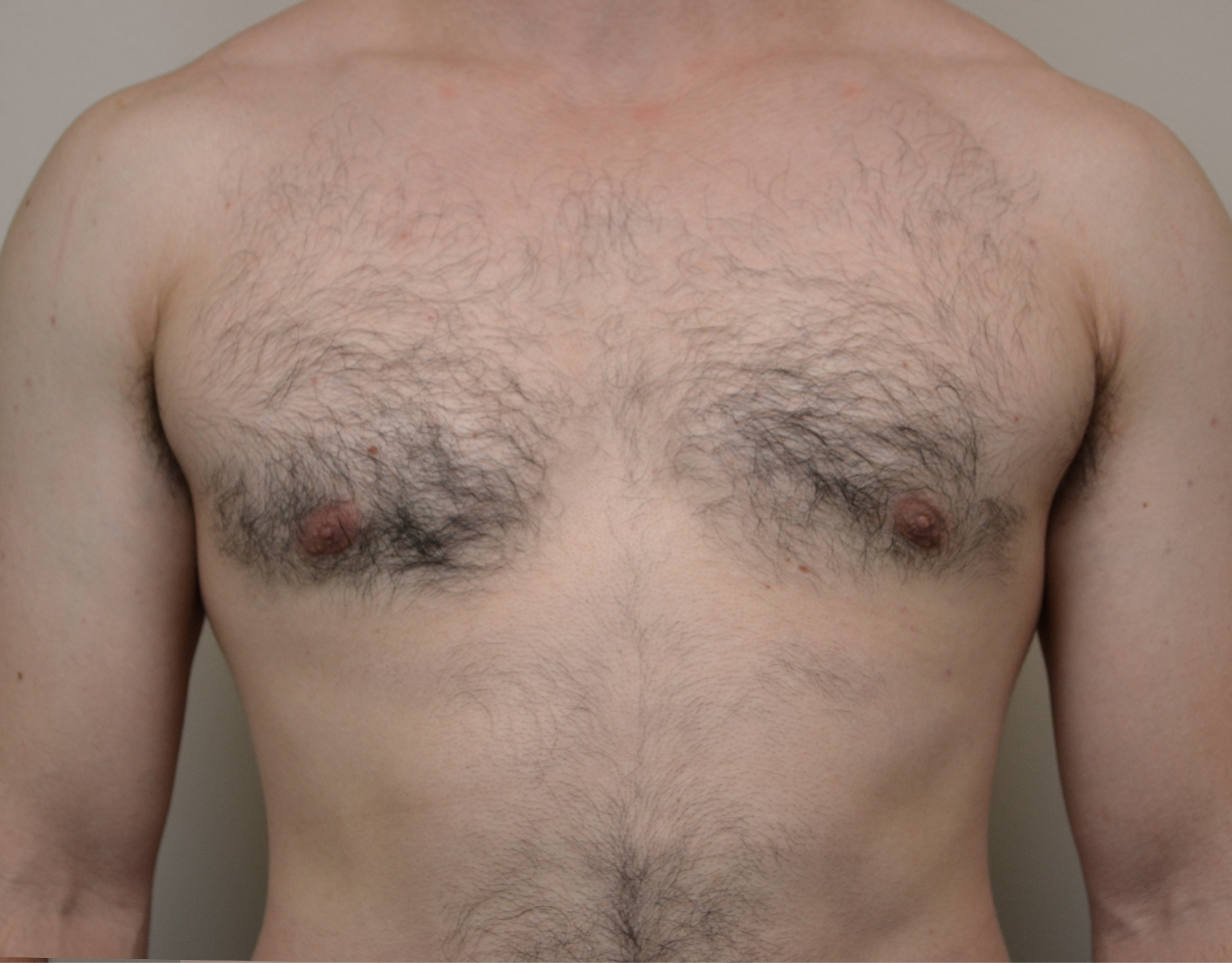 Gynecomastia Before & After Case 22
