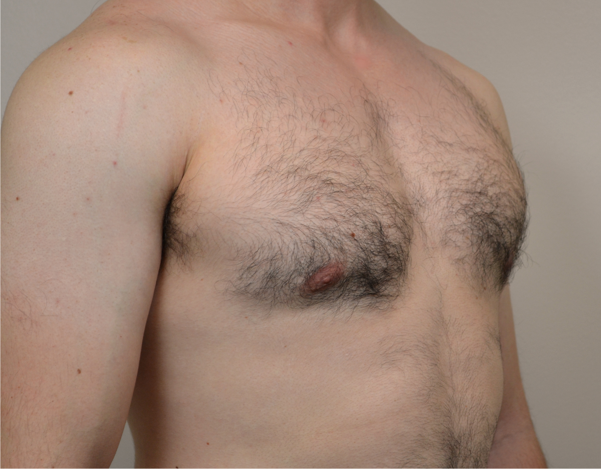 Gynecomastia Before & After Case 22