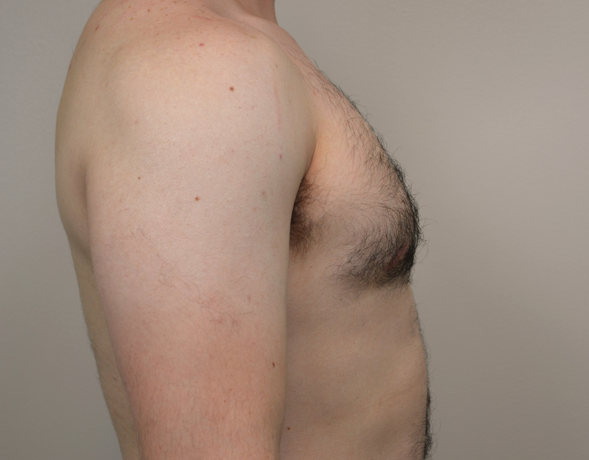 Gynecomastia Before & After Case 22