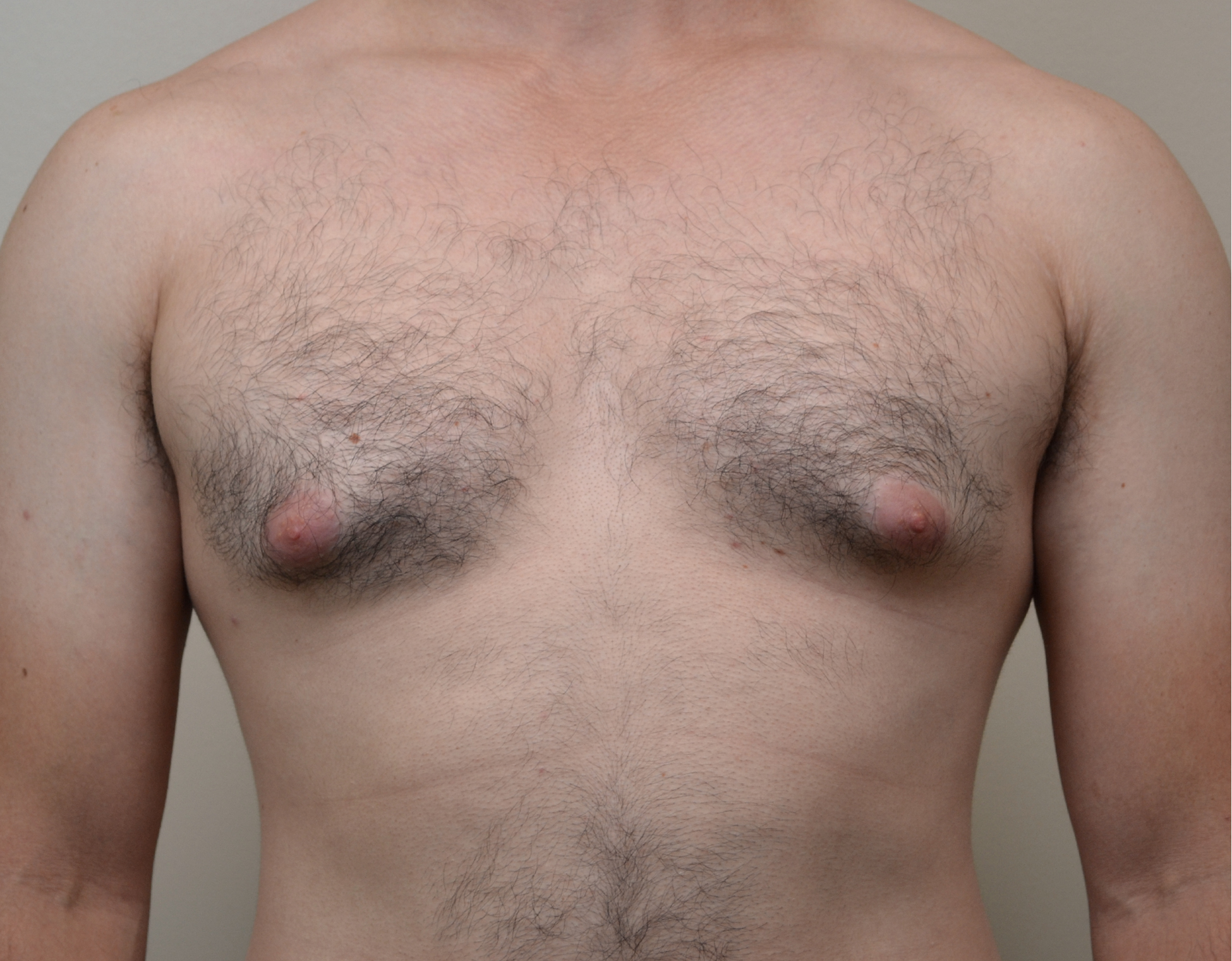 23 Gyno b1