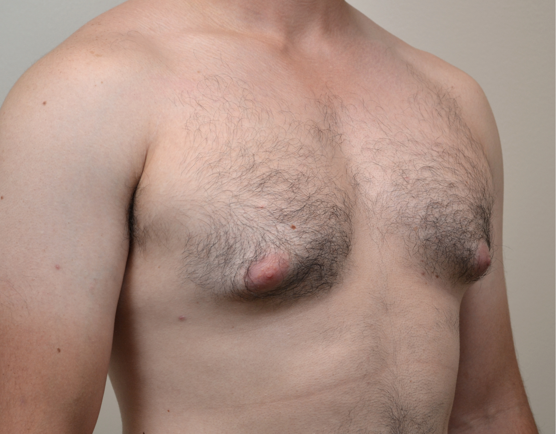 Gynecomastia Before & After Case 22