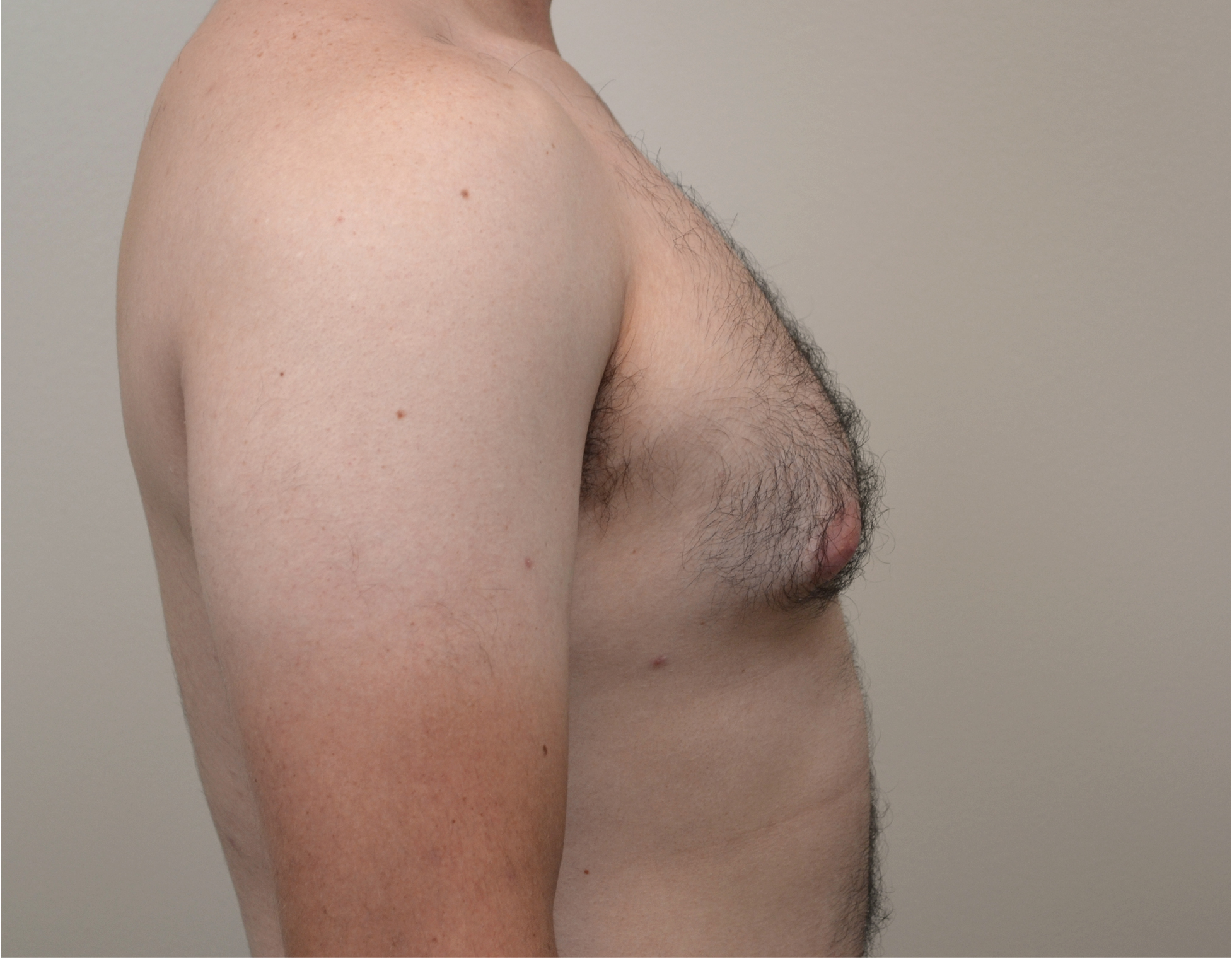 Gynecomastia Before & After Case 22