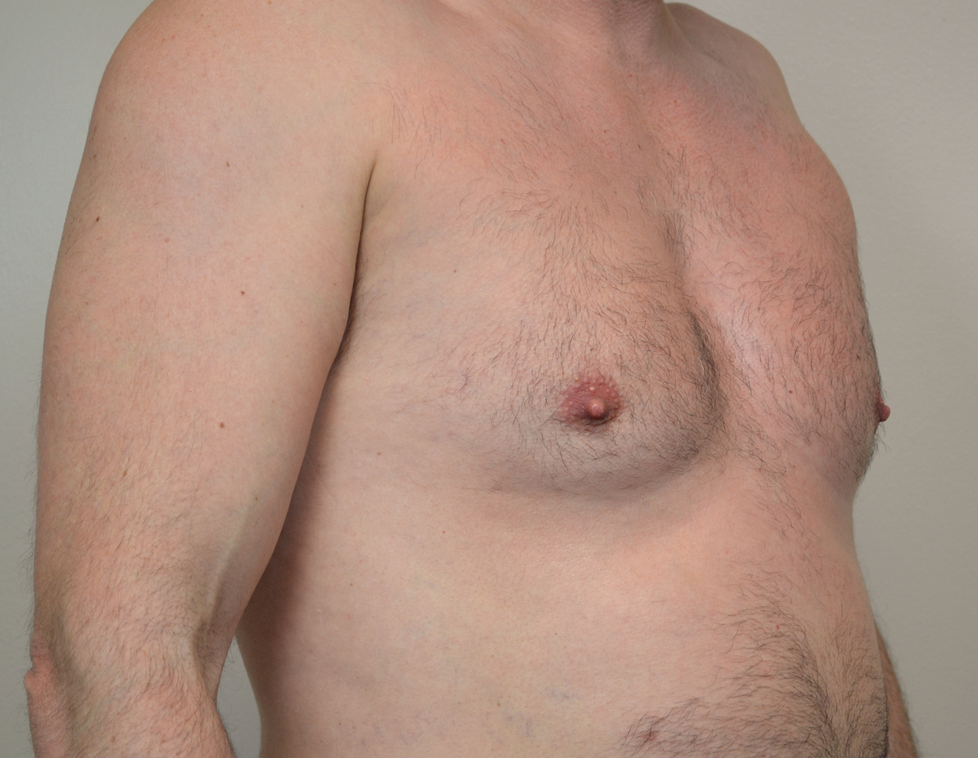 Gynecomastia Before & After Case 23