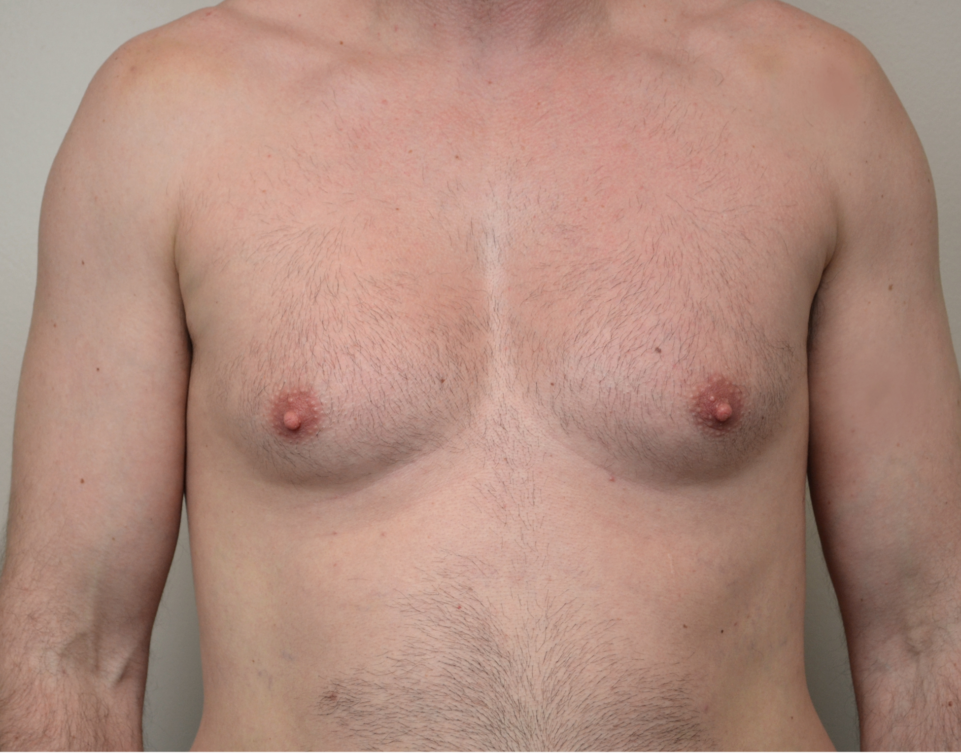 24 gyno b1