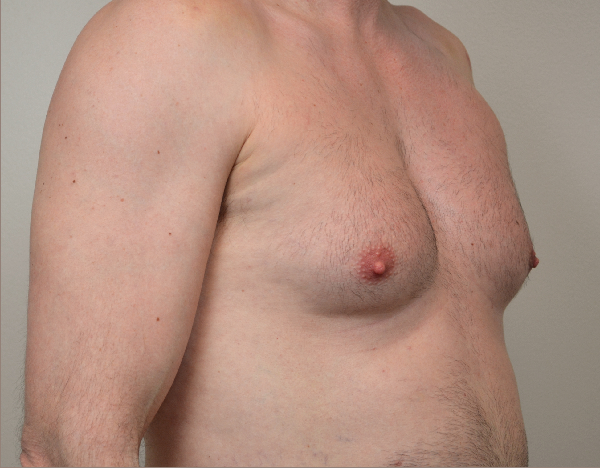 Gynecomastia Before & After Case 23