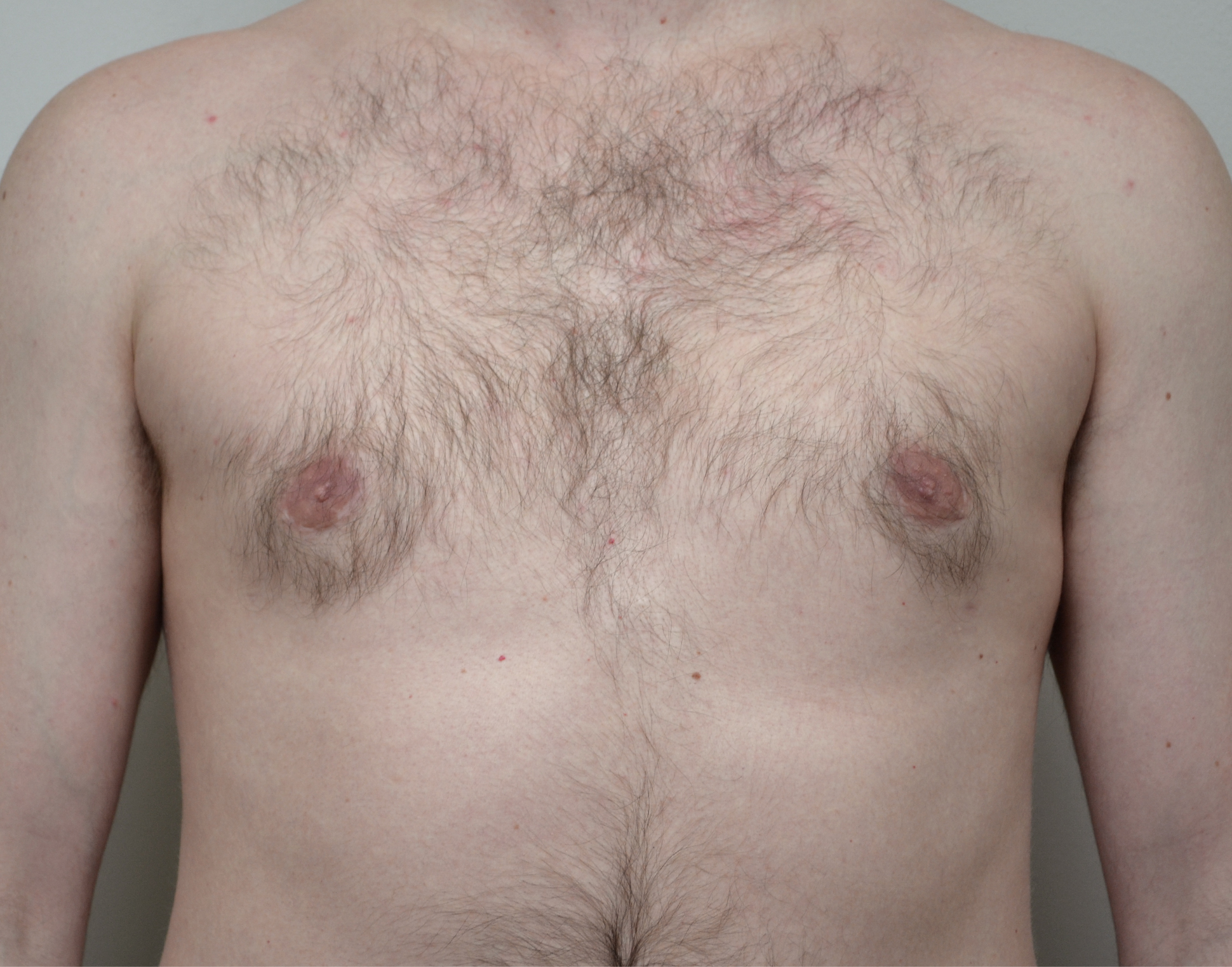 Gynecomastia Before & After Case 24