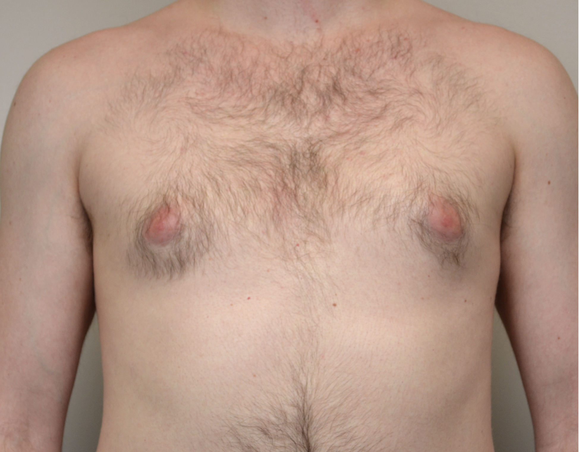 25 Gyno b1