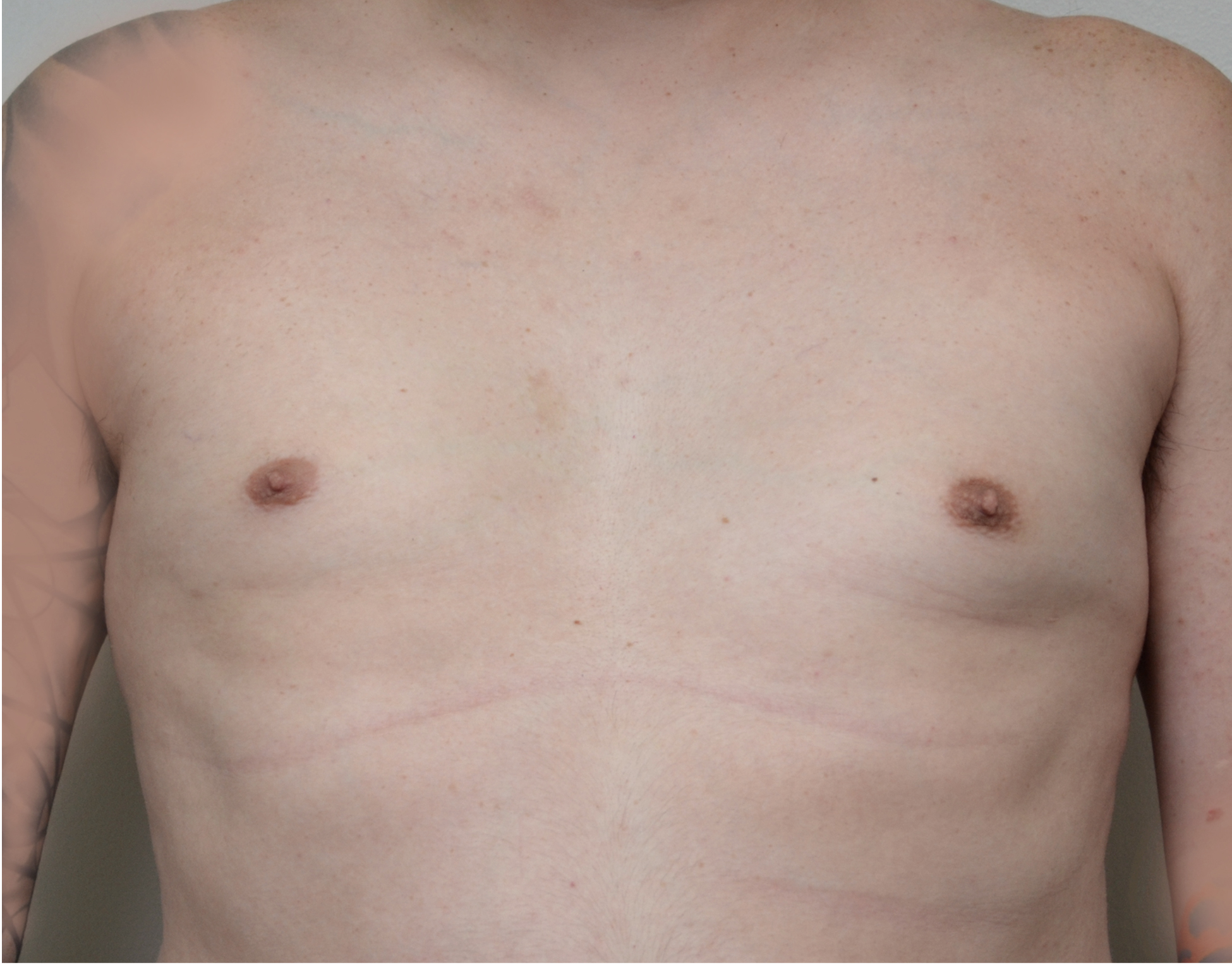 Gynecomastia Before & After Case 26