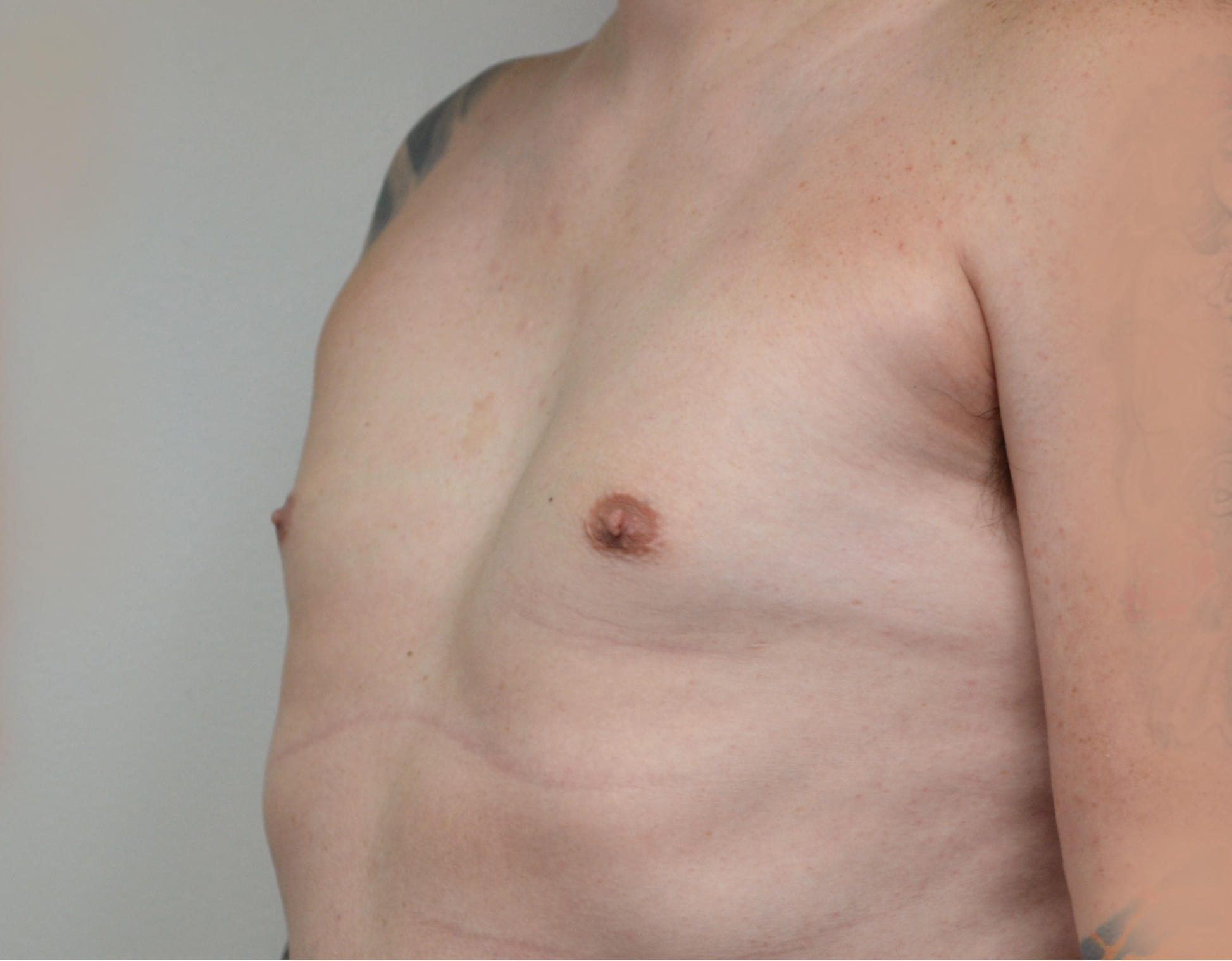 Gynecomastia Before & After Case 26