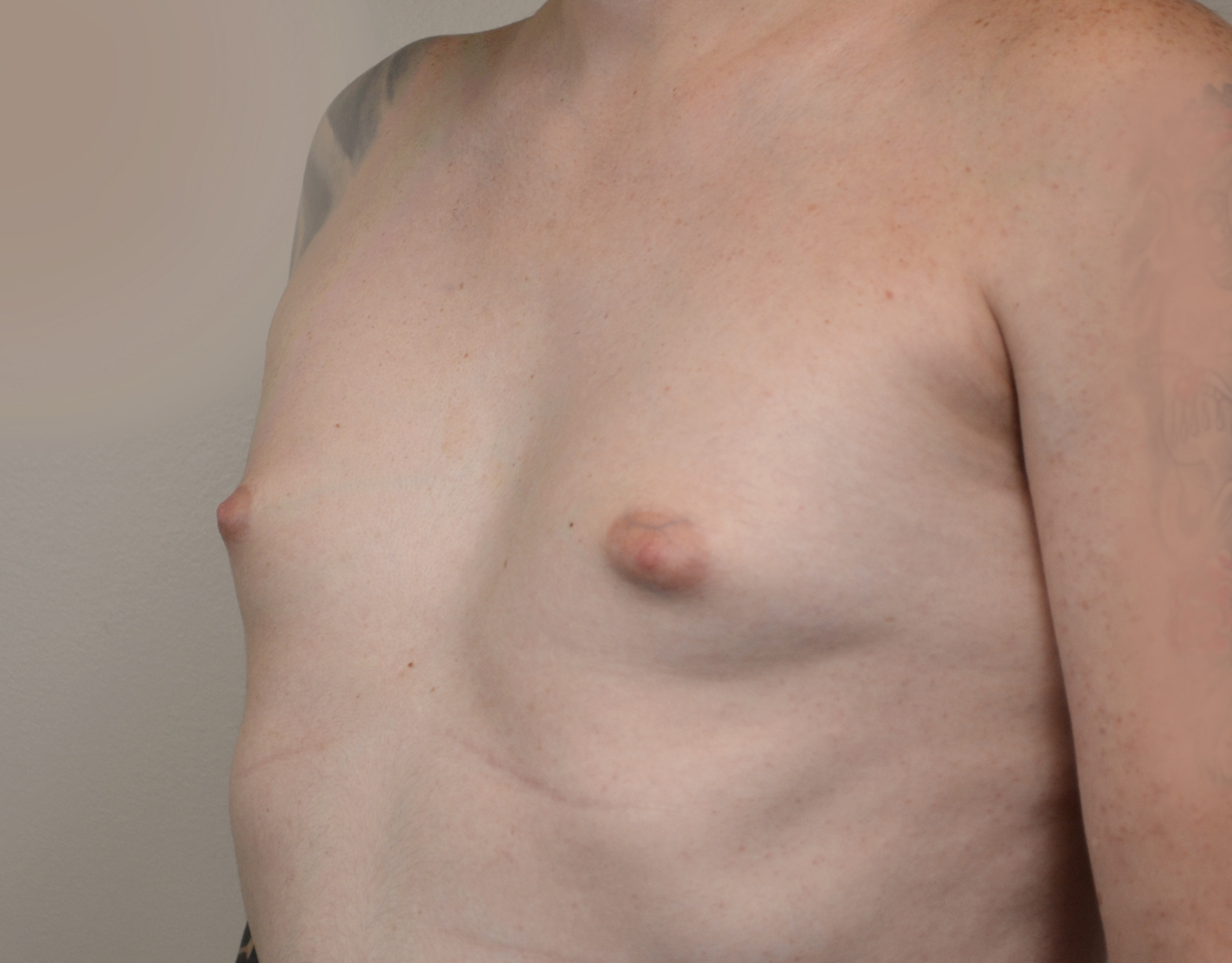 Gynecomastia Before & After Case 26