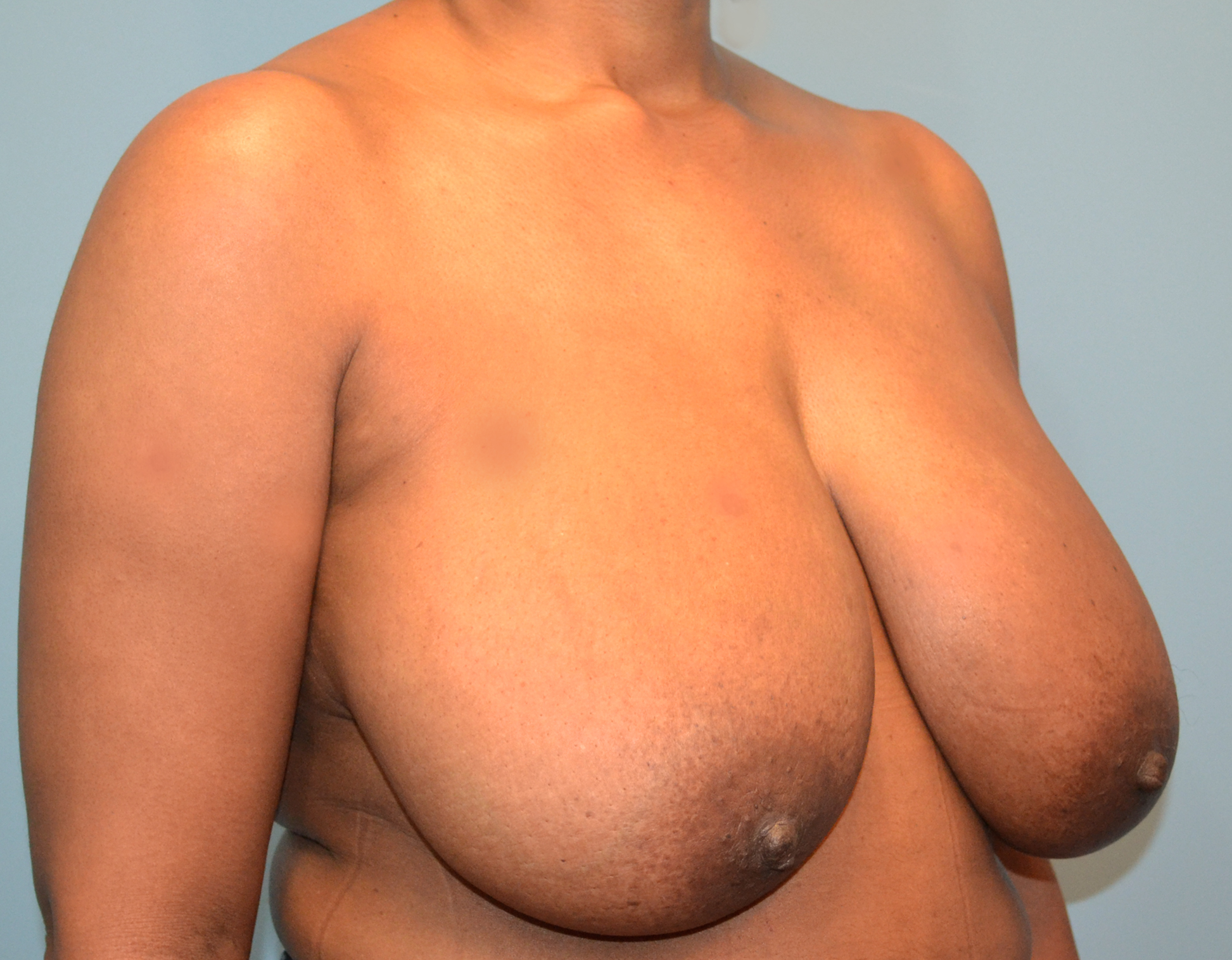 Breast Reduction Before & After Case 3095