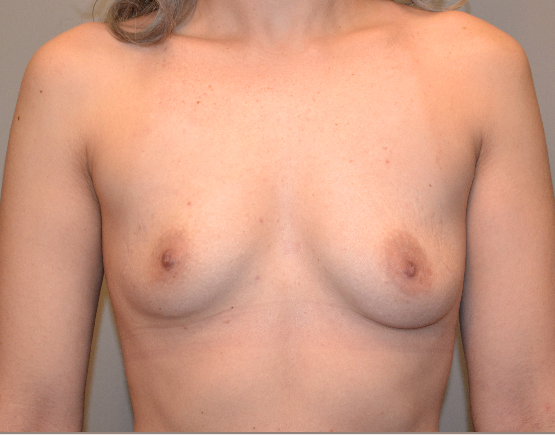 4702 Breast Augmentation b1
