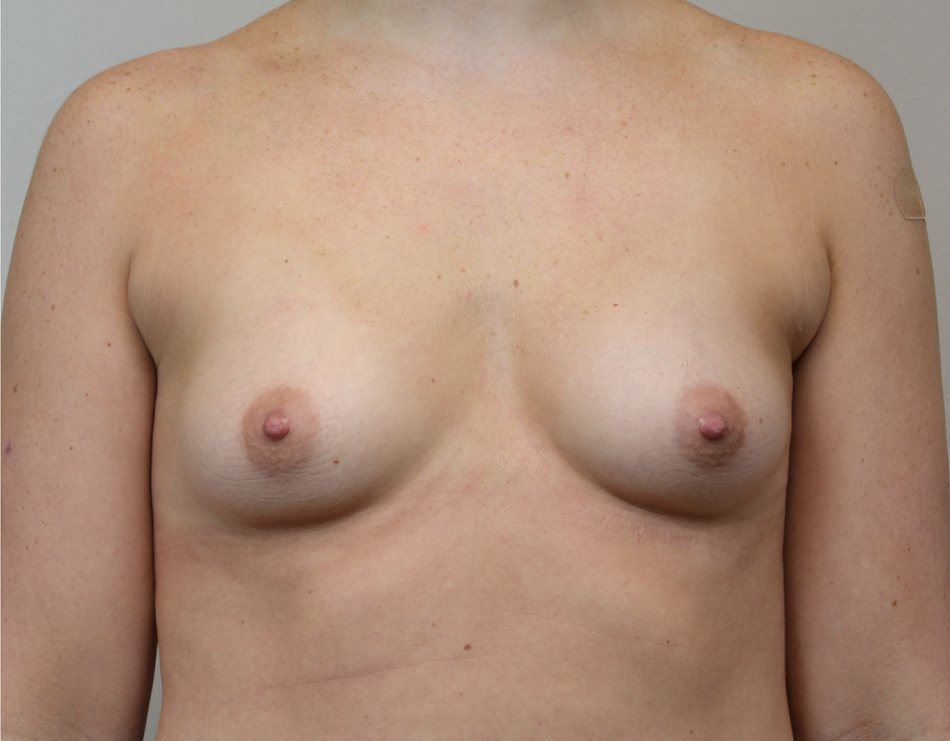 4703 breast Augmention b1