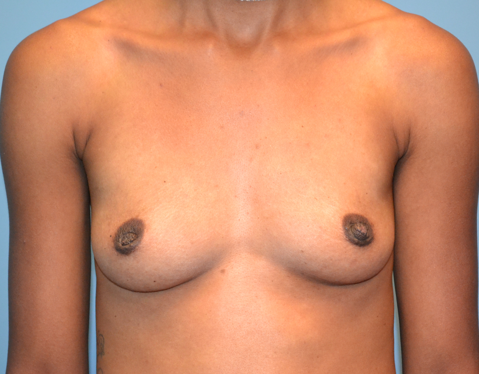 4704 Breast Augmentation b1 jpg