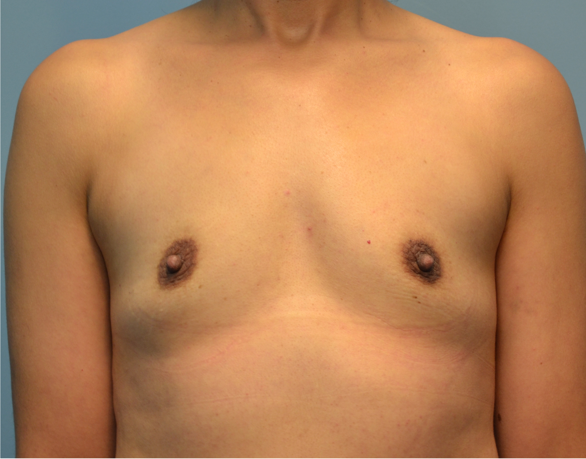 4706 Breast Augmentation b1