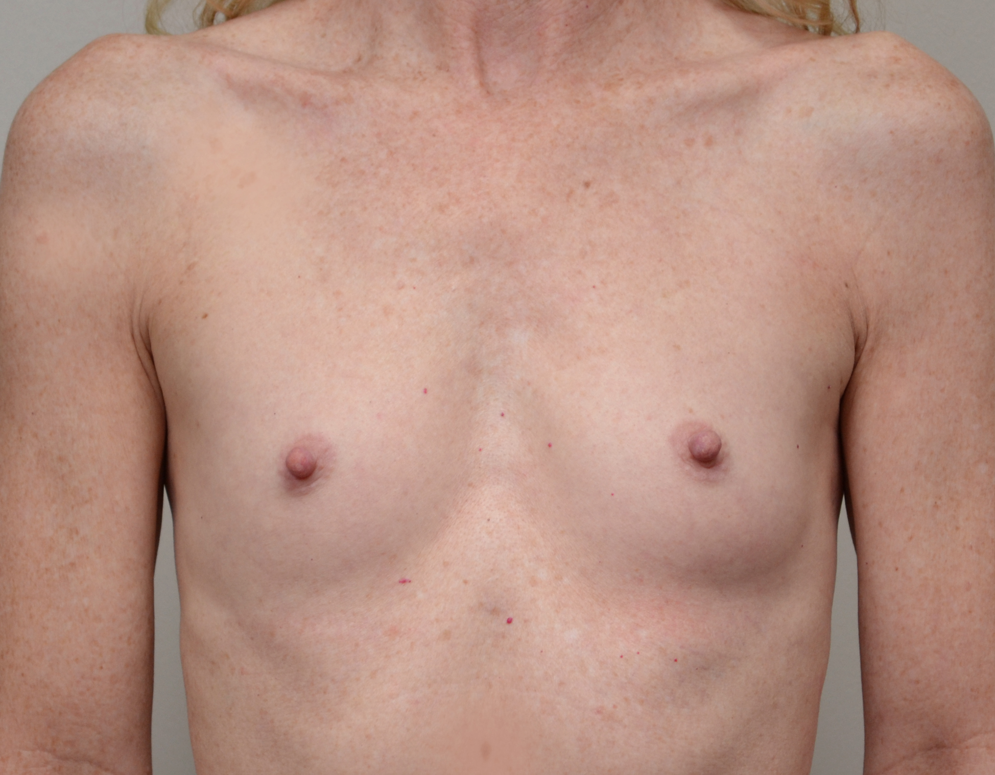 4709 Breast Augmentation b1
