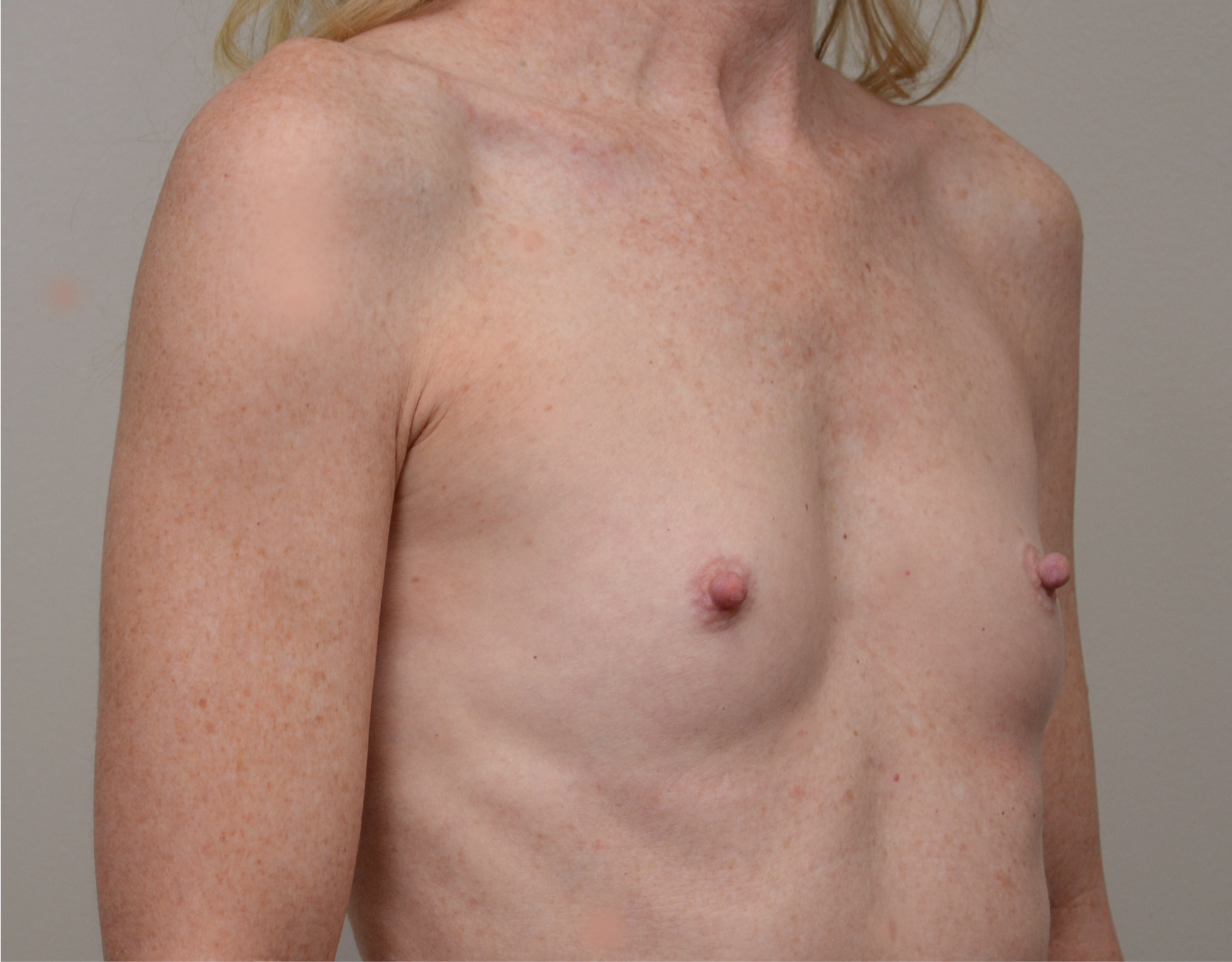 Breast Augmentation Before & After Case 4709