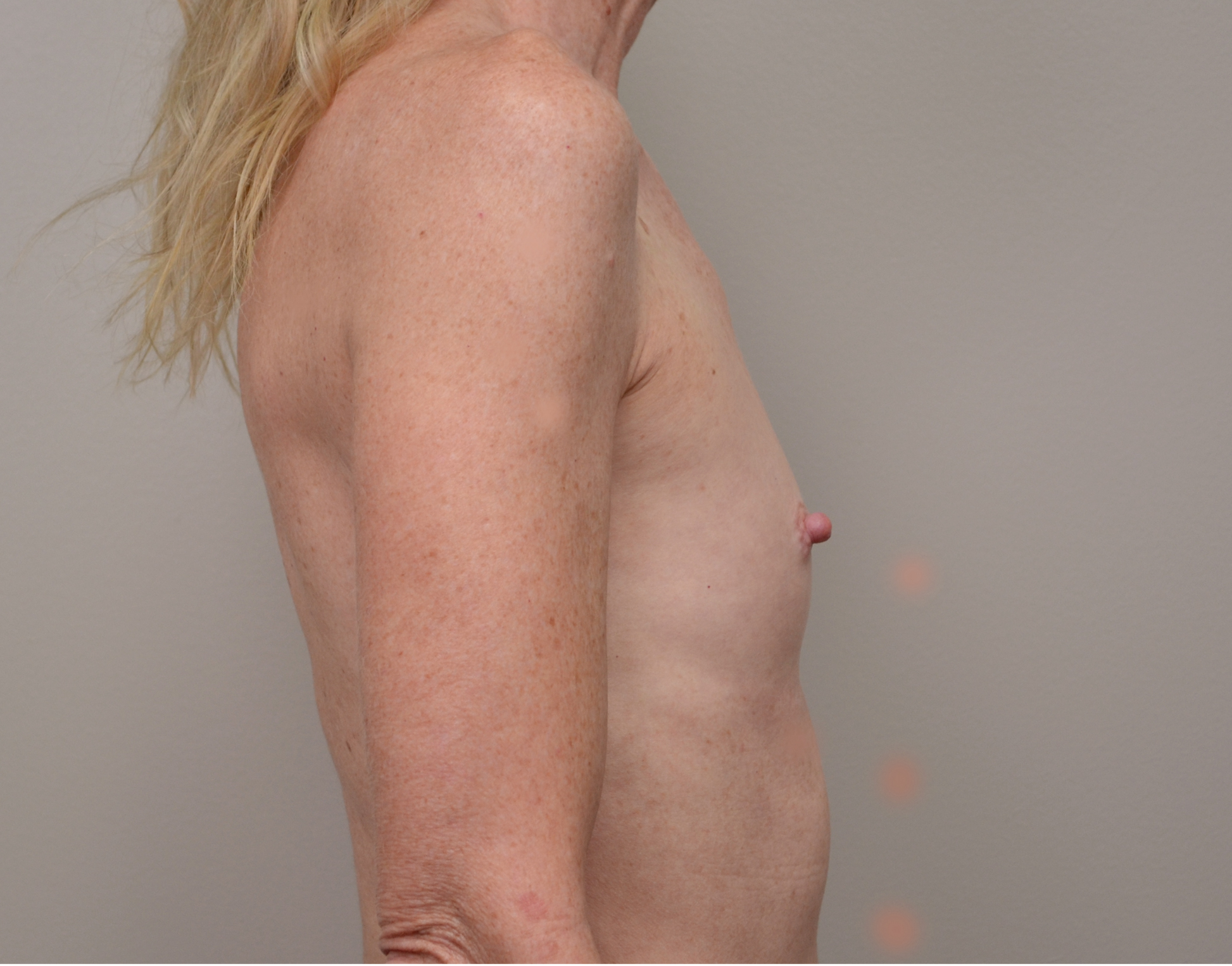 Breast Augmentation Before & After Case 4709