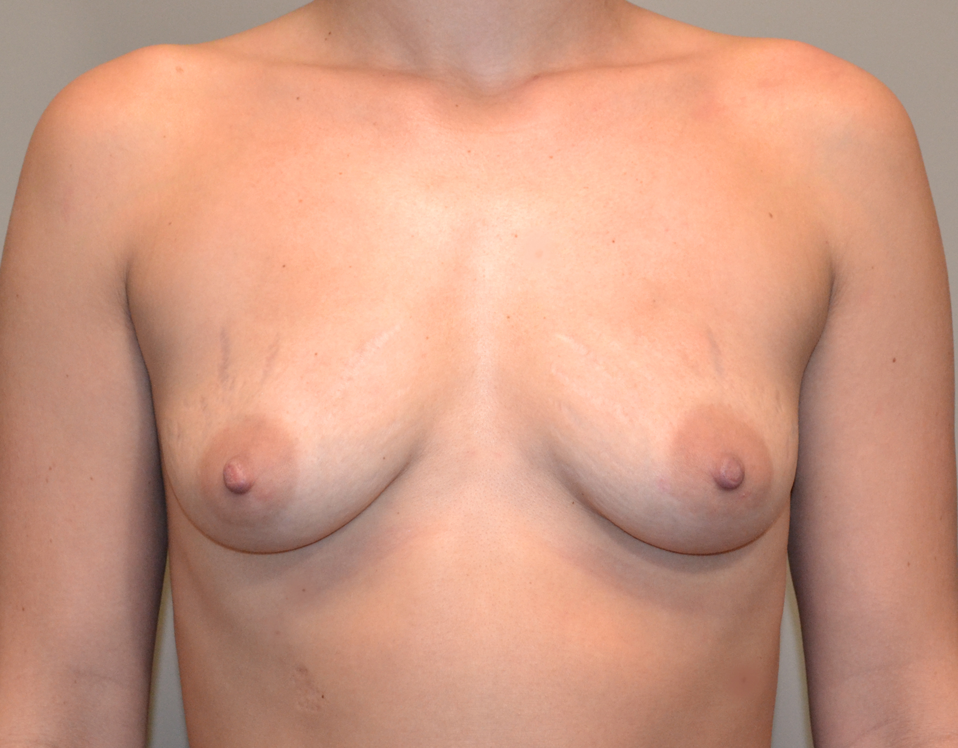 4710 Breast Augmentation b1