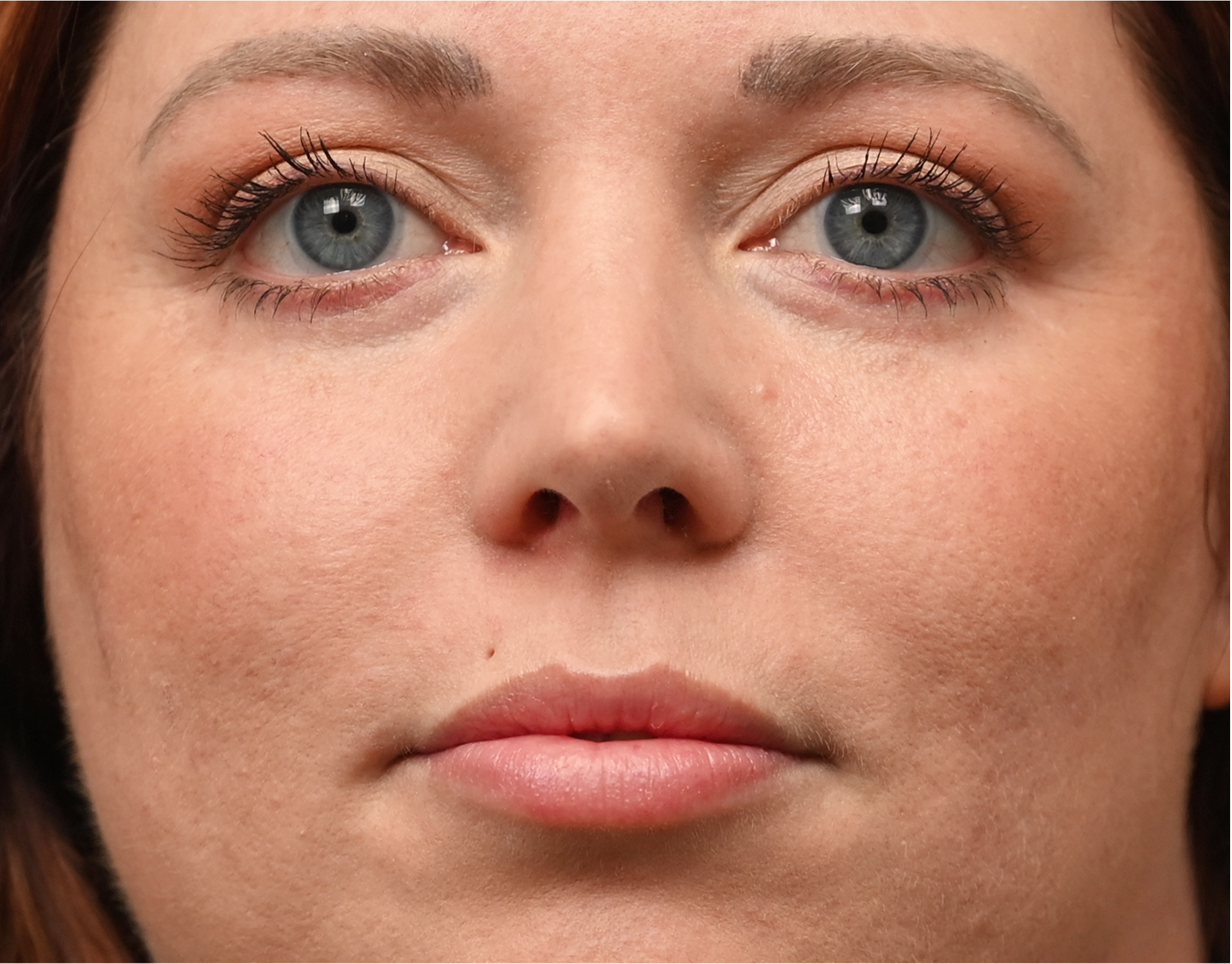 Eyelid Surgery (Blepharoplasty) Before & After Case 1