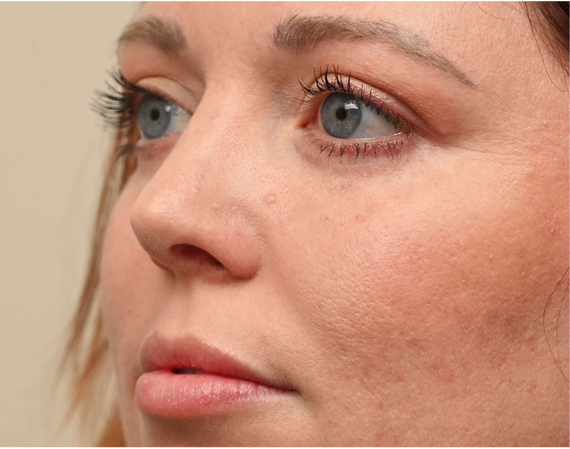 Eyelid Surgery (Blepharoplasty) Before & After Case 1