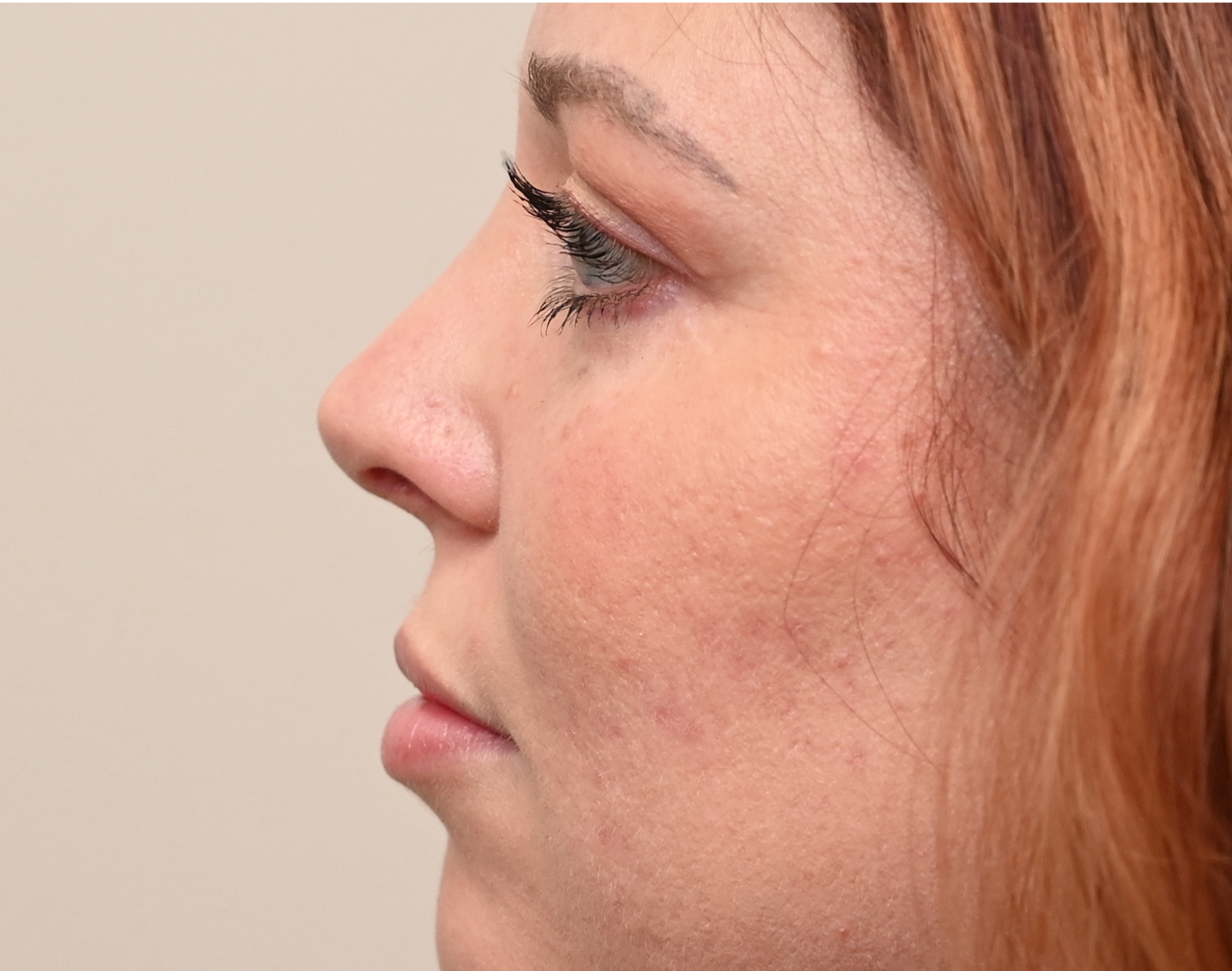 Eyelid Surgery (Blepharoplasty) Before & After Case 1