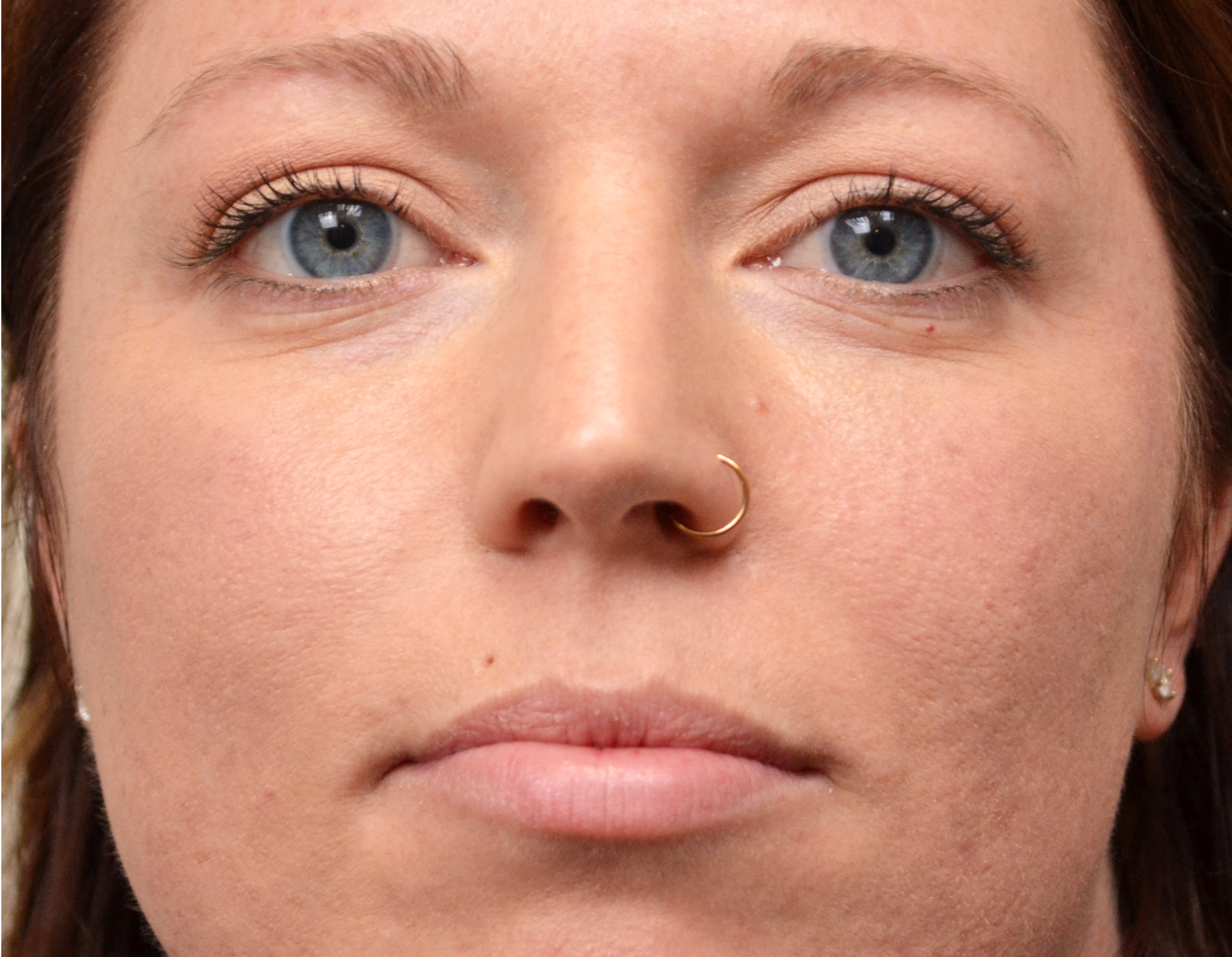 Eyelid Surgery (Blepharoplasty) Before & After Case 1