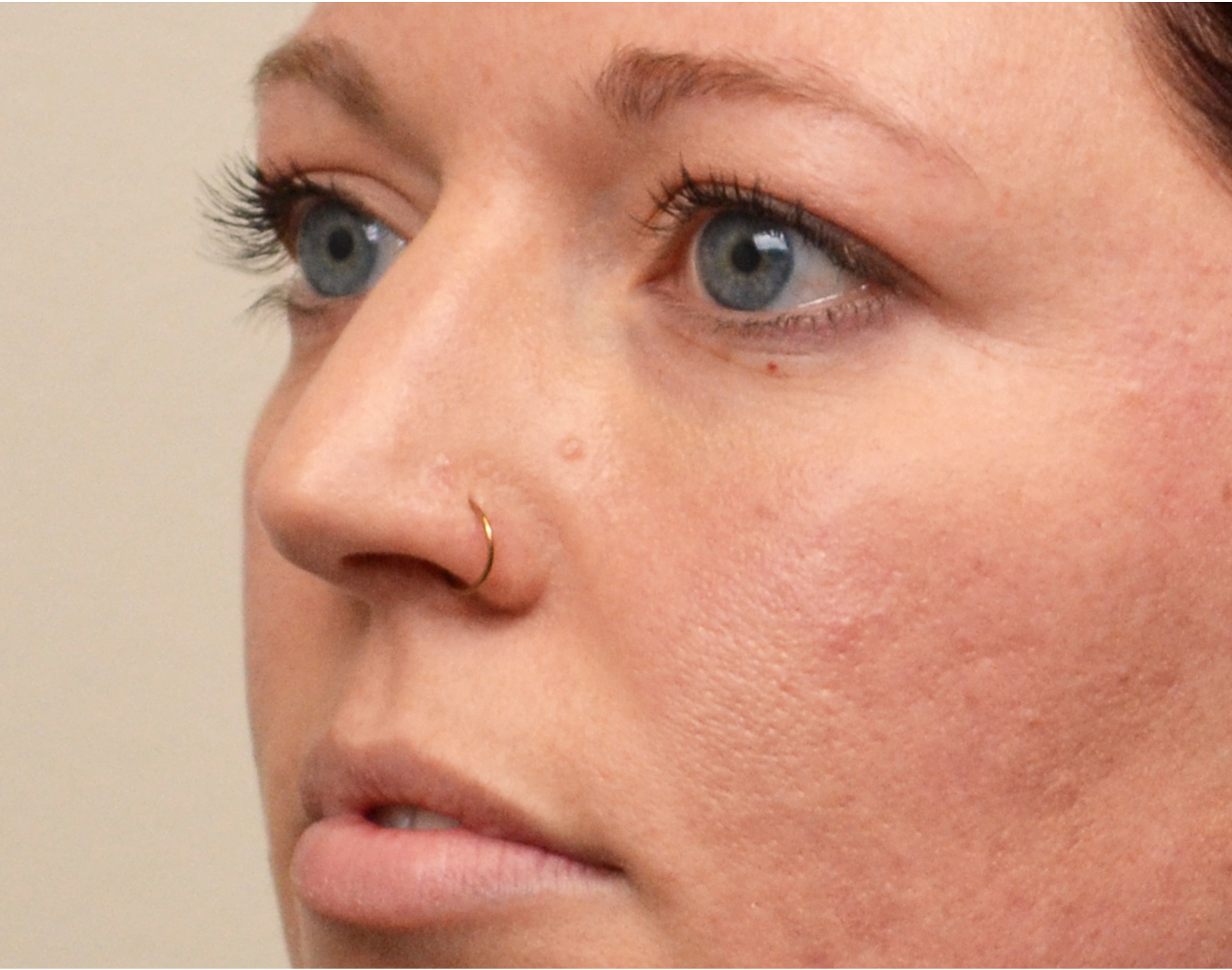 Eyelid Surgery (Blepharoplasty) Before & After Case 1