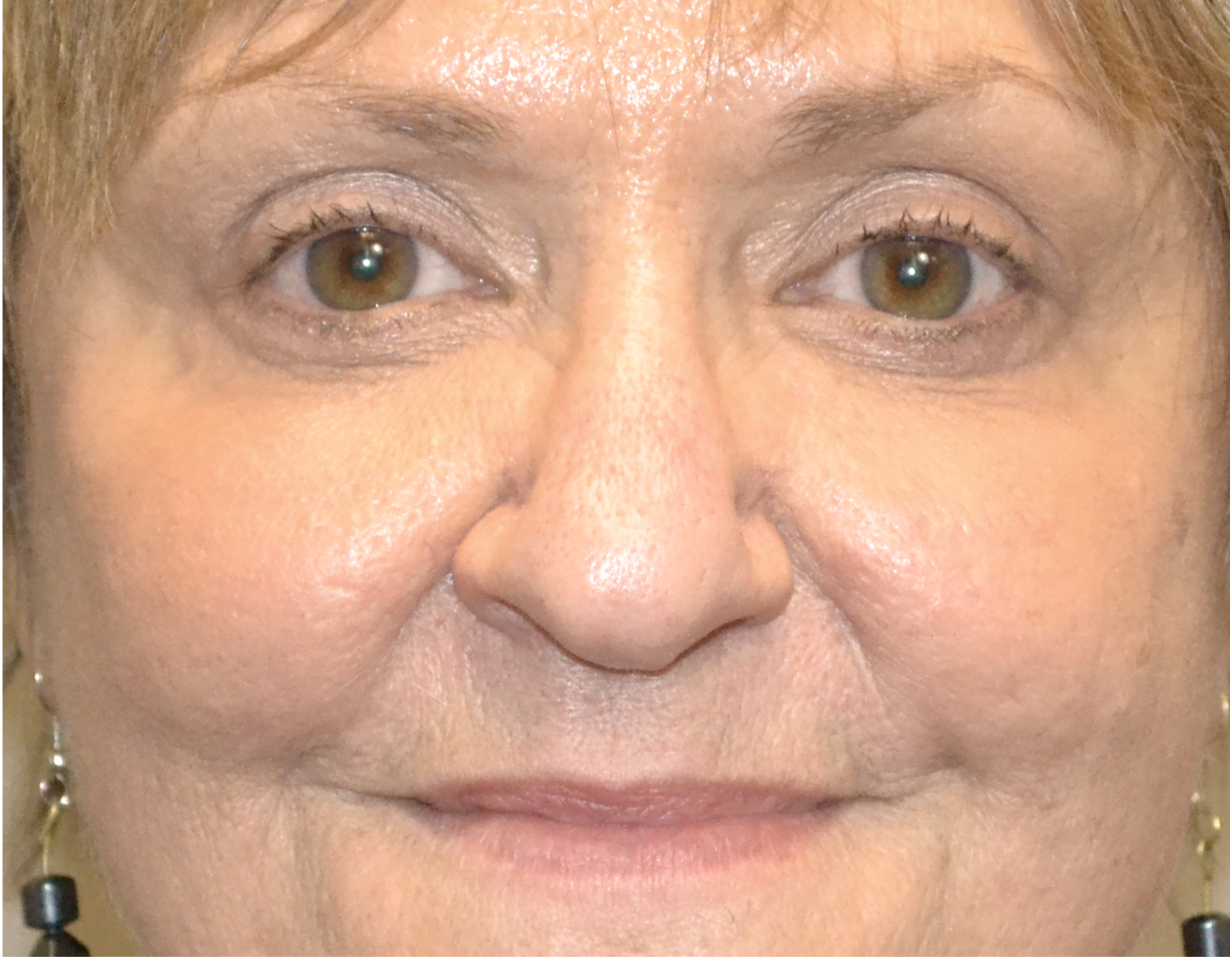 Eyelid Surgery (Blepharoplasty) Before & After Case 10