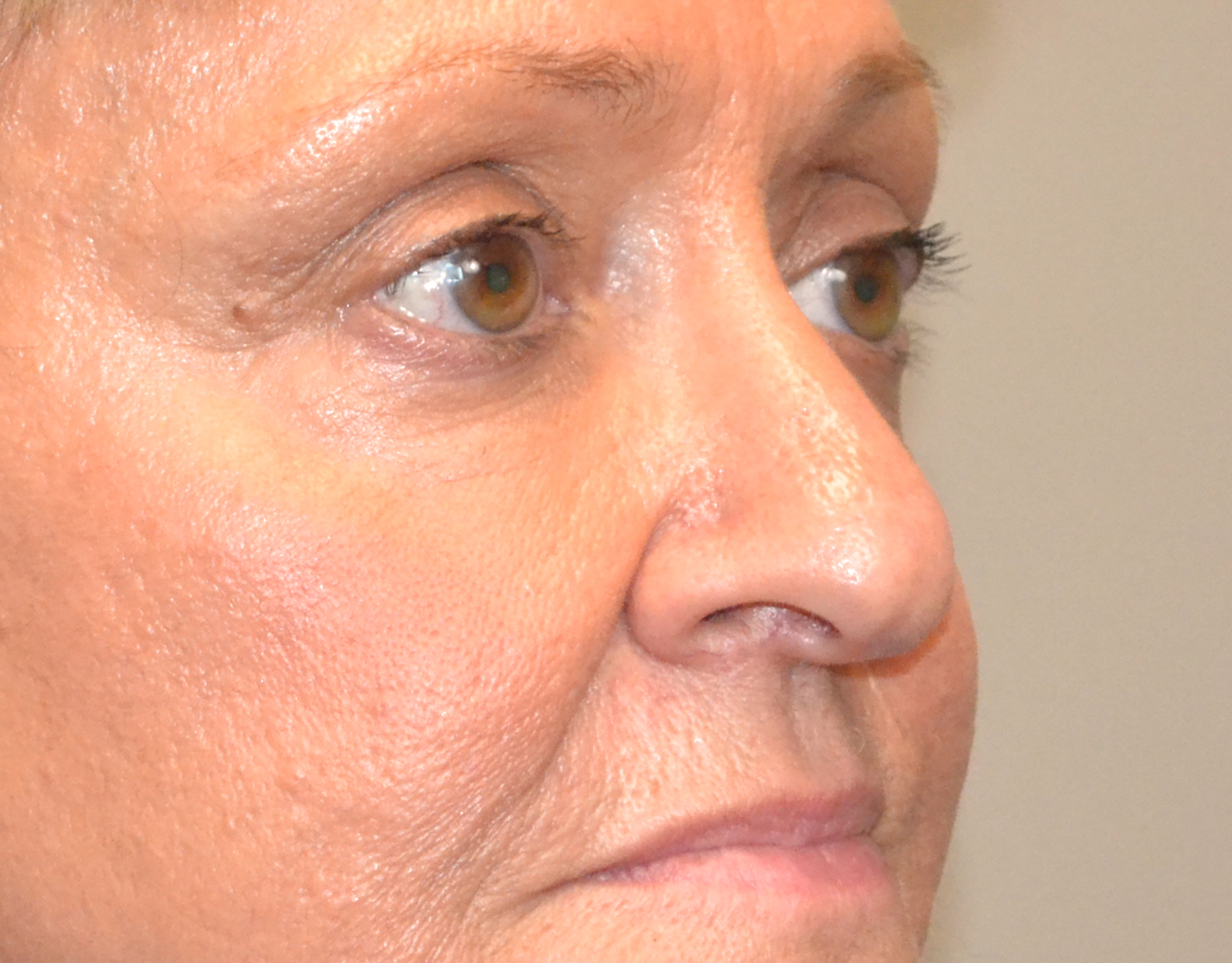 Eyelid Surgery (Blepharoplasty) Before & After Case 10