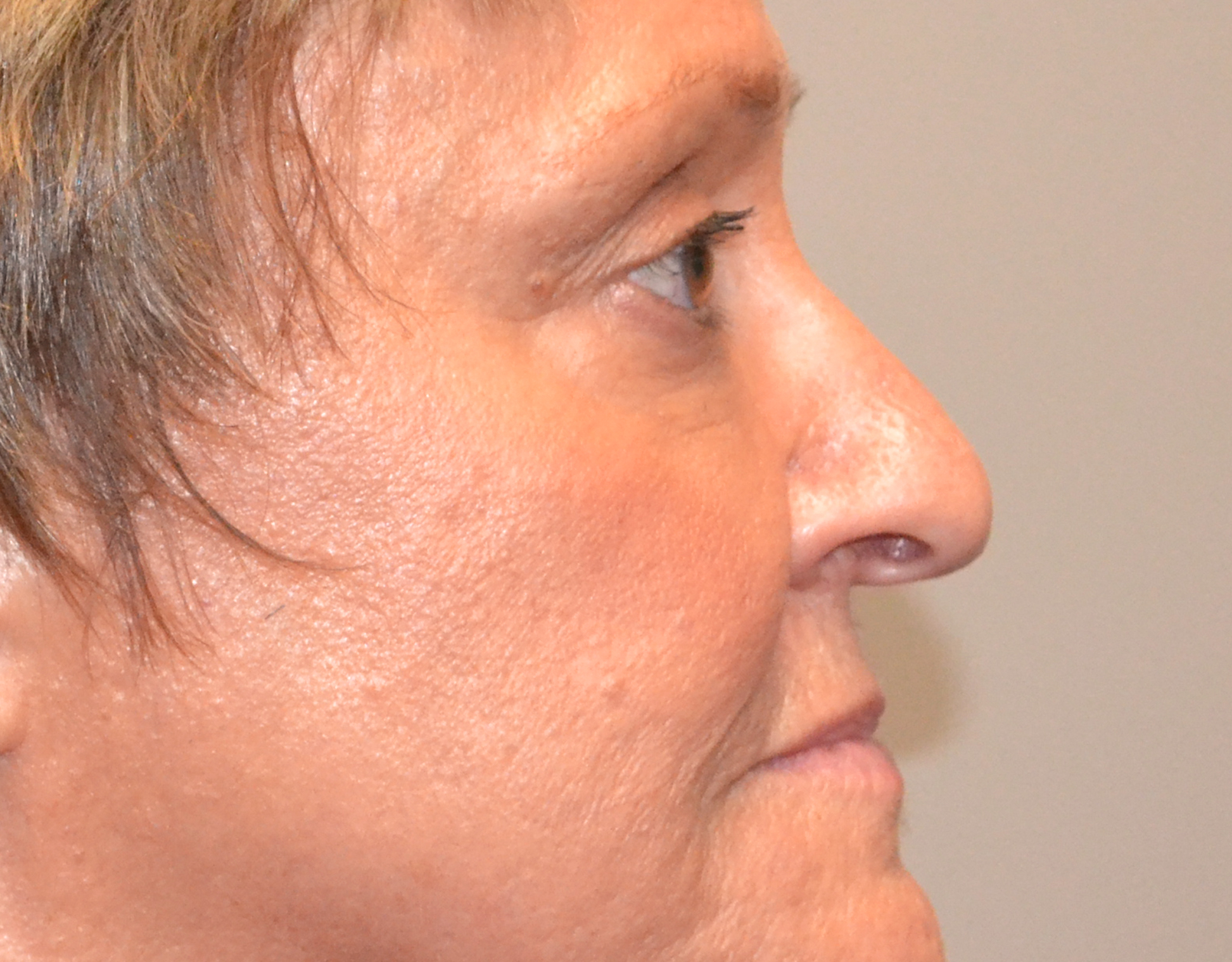 Eyelid Surgery (Blepharoplasty) Before & After Case 10