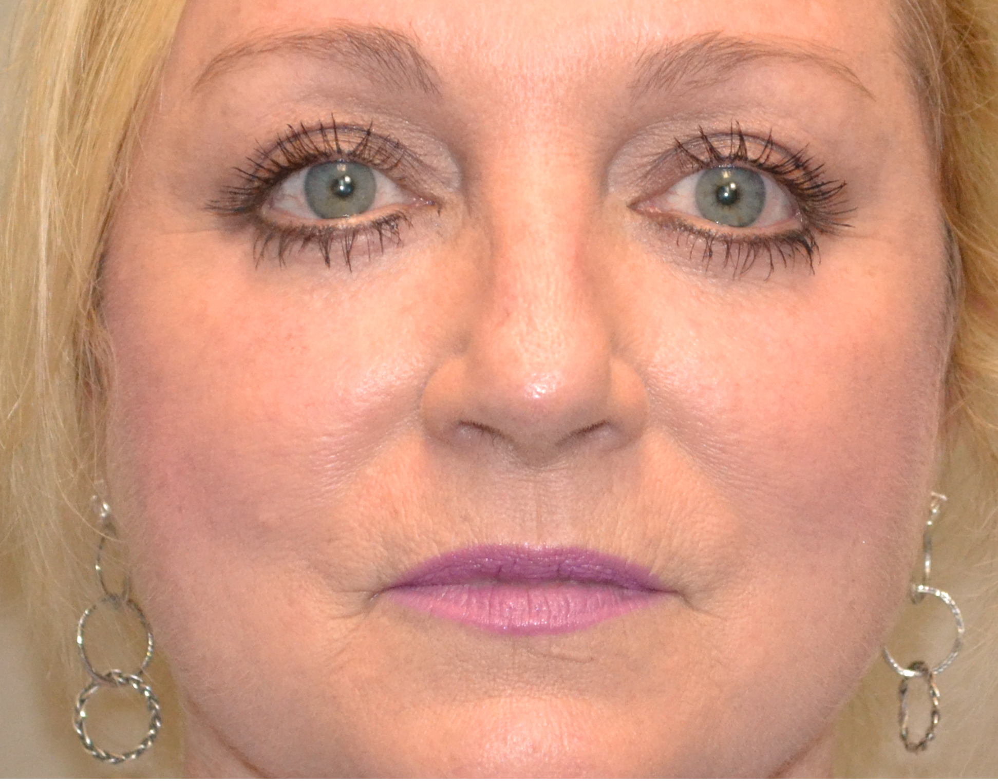 Eyelid Surgery (Blepharoplasty) Before & After Case 2