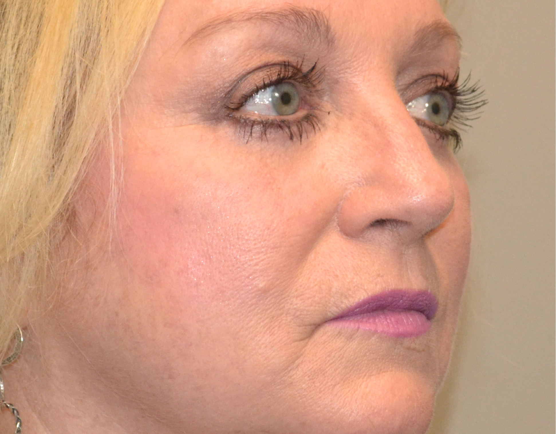 Eyelid Surgery (Blepharoplasty) Before & After Case 2