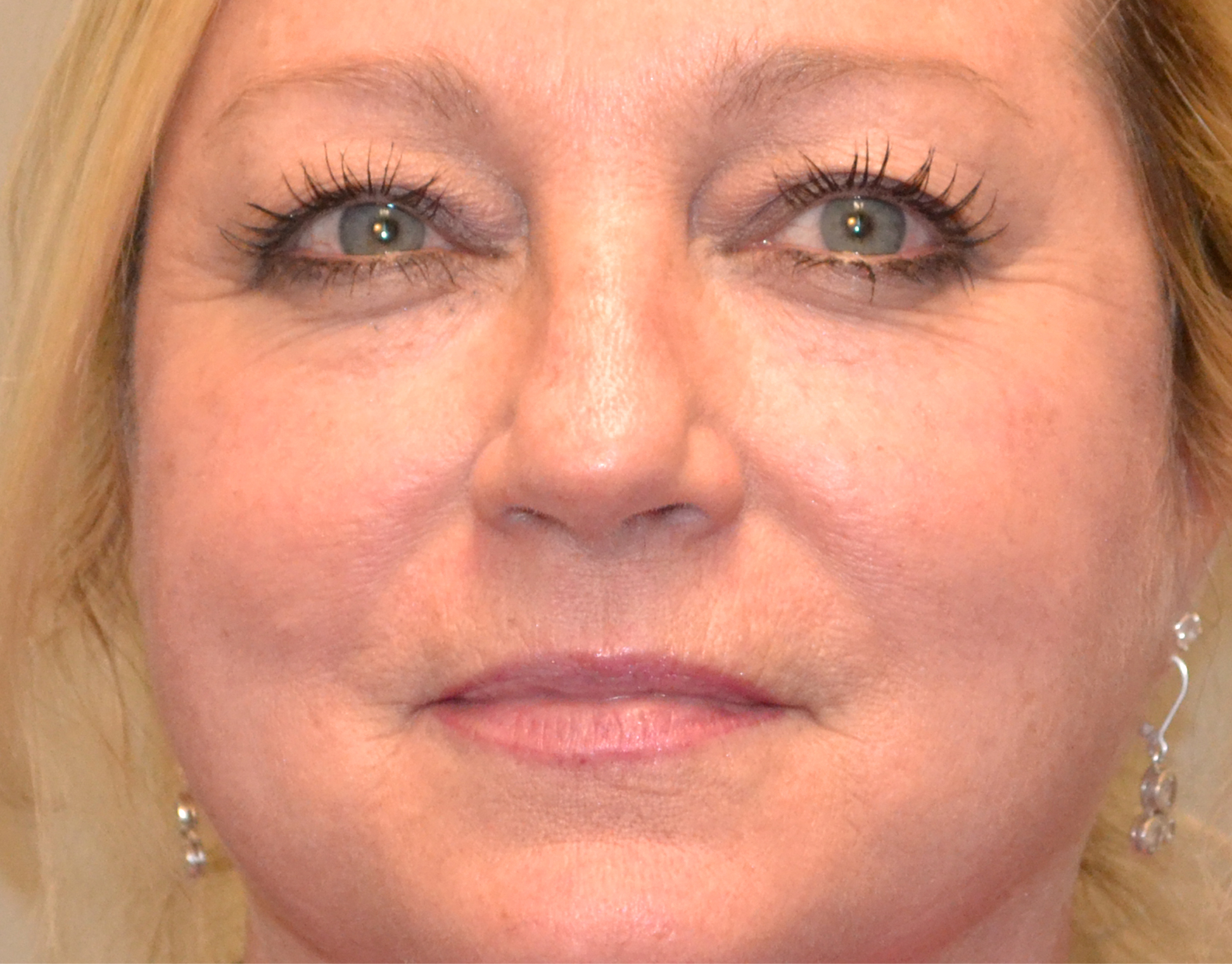 Eyelid Surgery (Blepharoplasty) Before & After Case 2