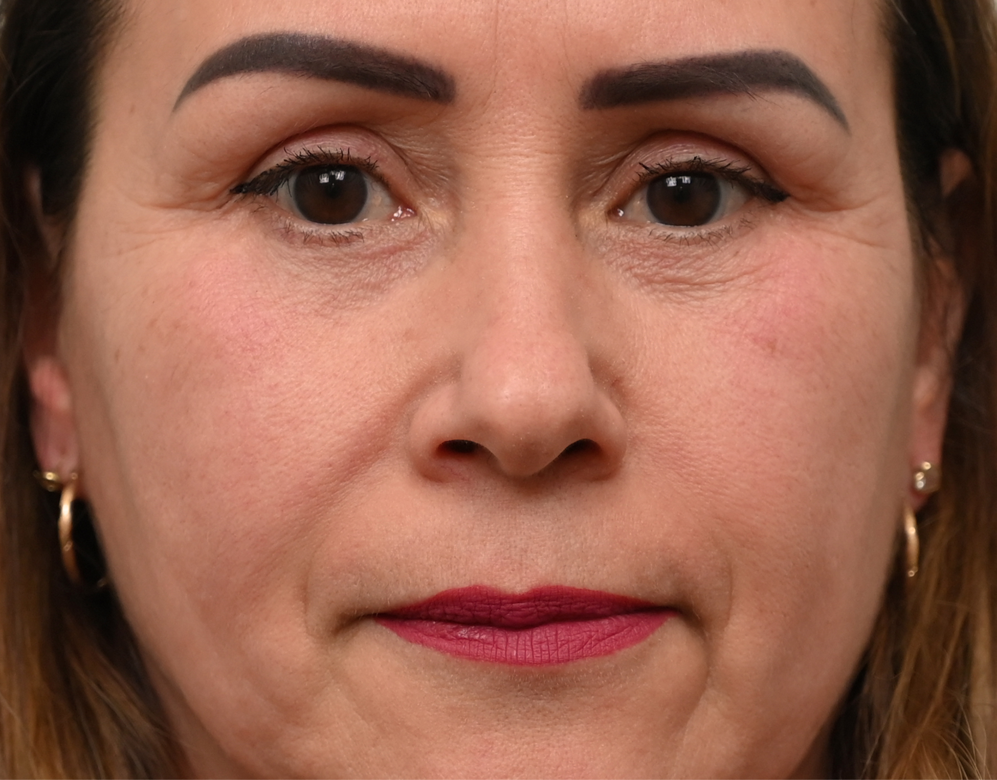 Eyelid Surgery (Blepharoplasty) Before & After Case 3