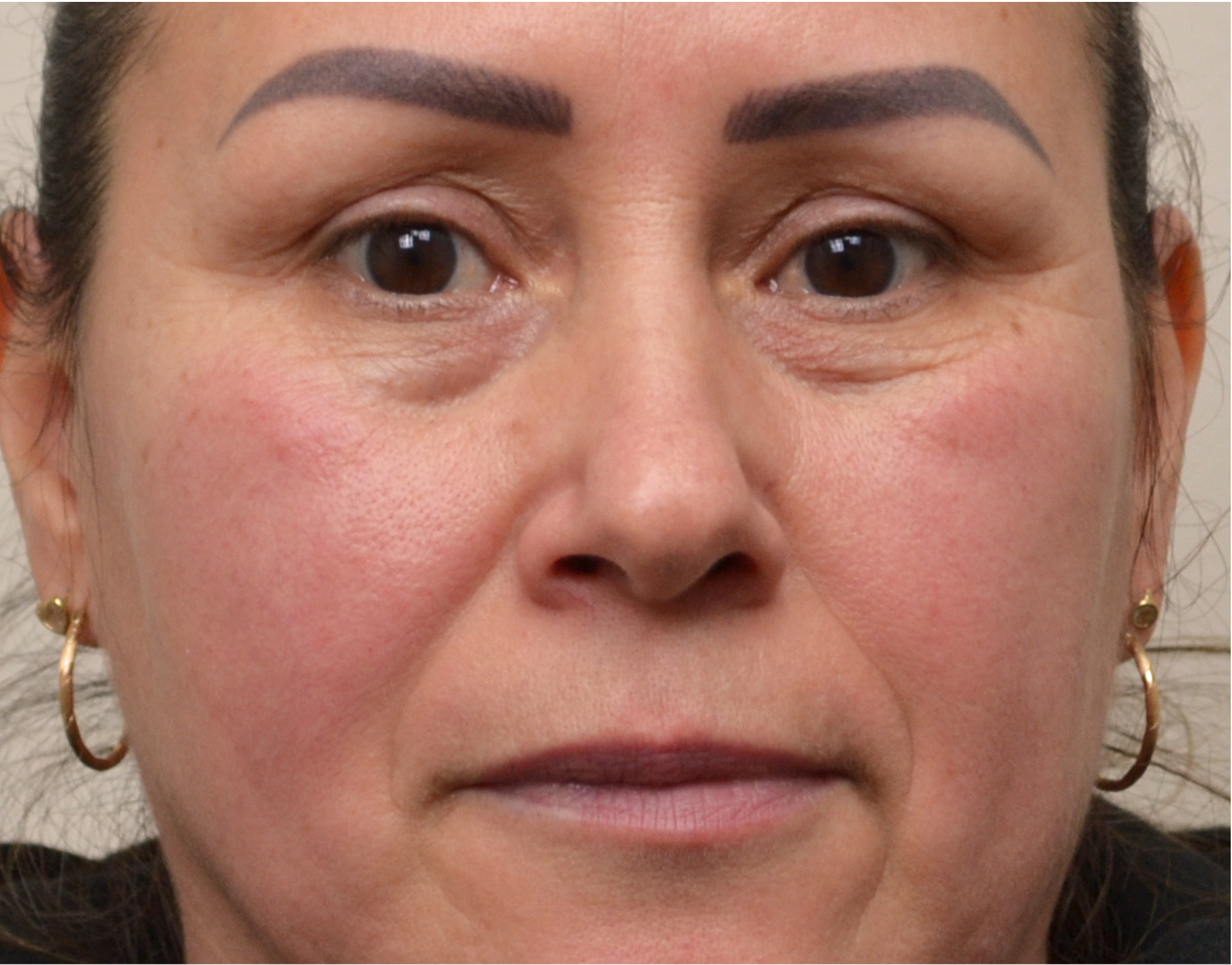 Eyelid Surgery (Blepharoplasty) Before & After Case 3