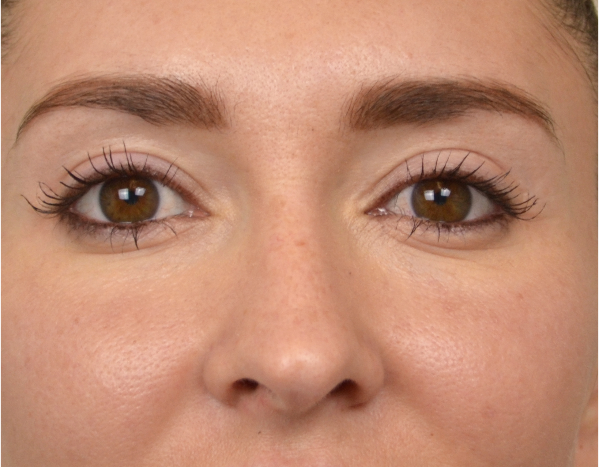 Eyelid Surgery (Blepharoplasty) Before & After Case 4