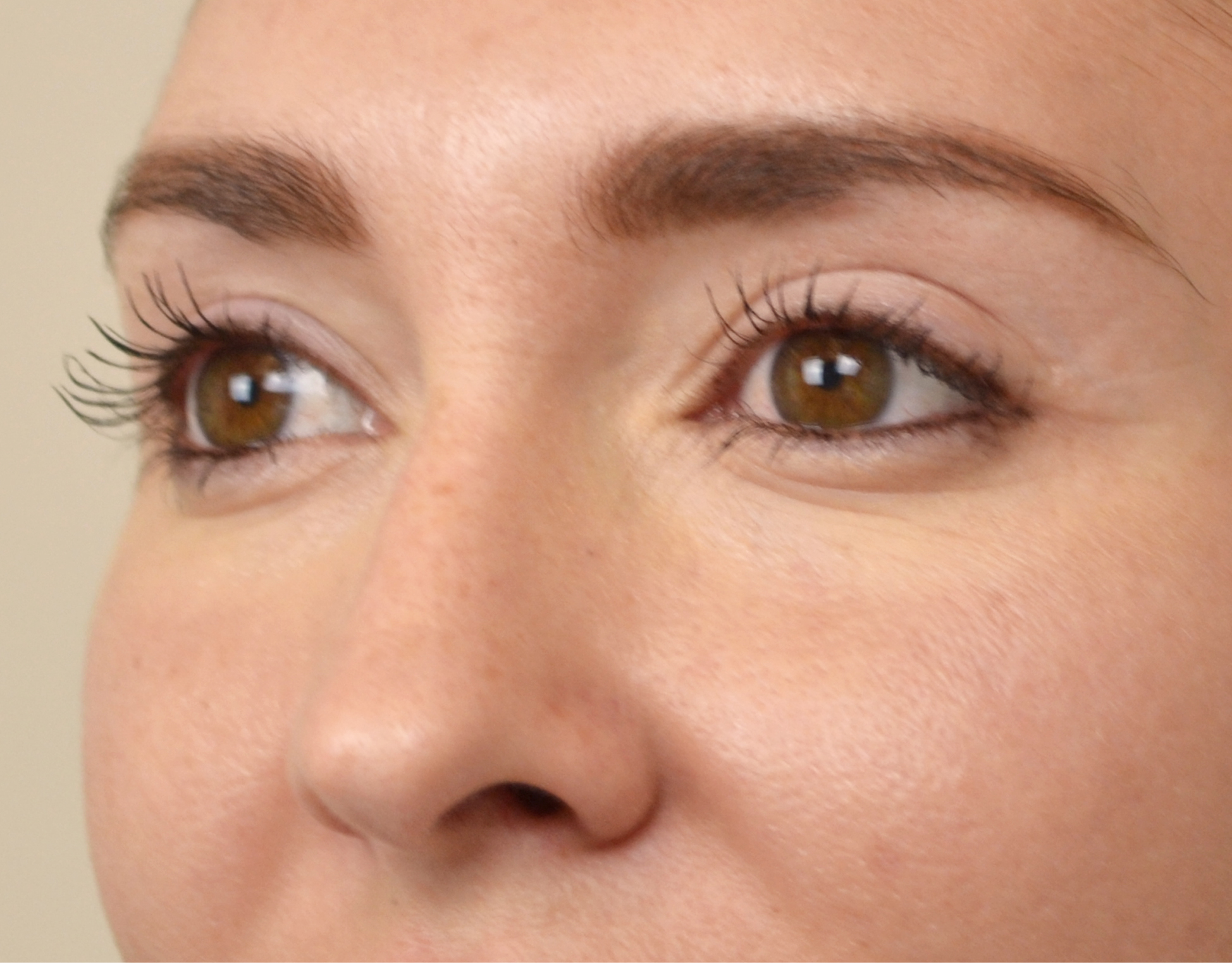 Eyelid Surgery (Blepharoplasty) Before & After Case 4