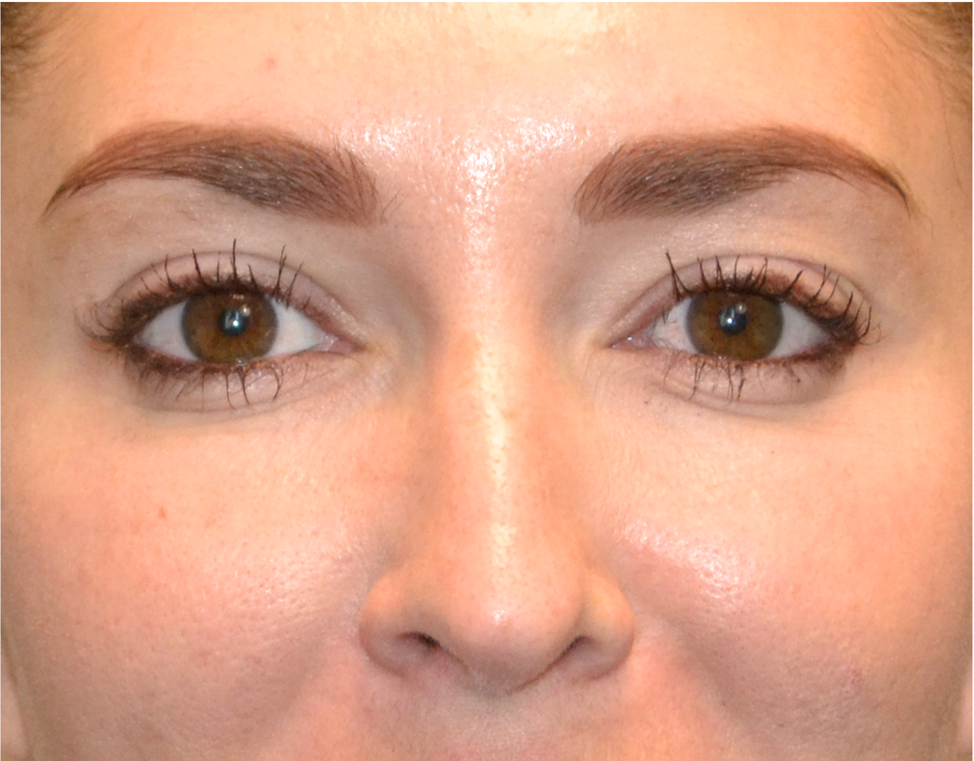 Eyelid Surgery (Blepharoplasty) Before & After Case 4