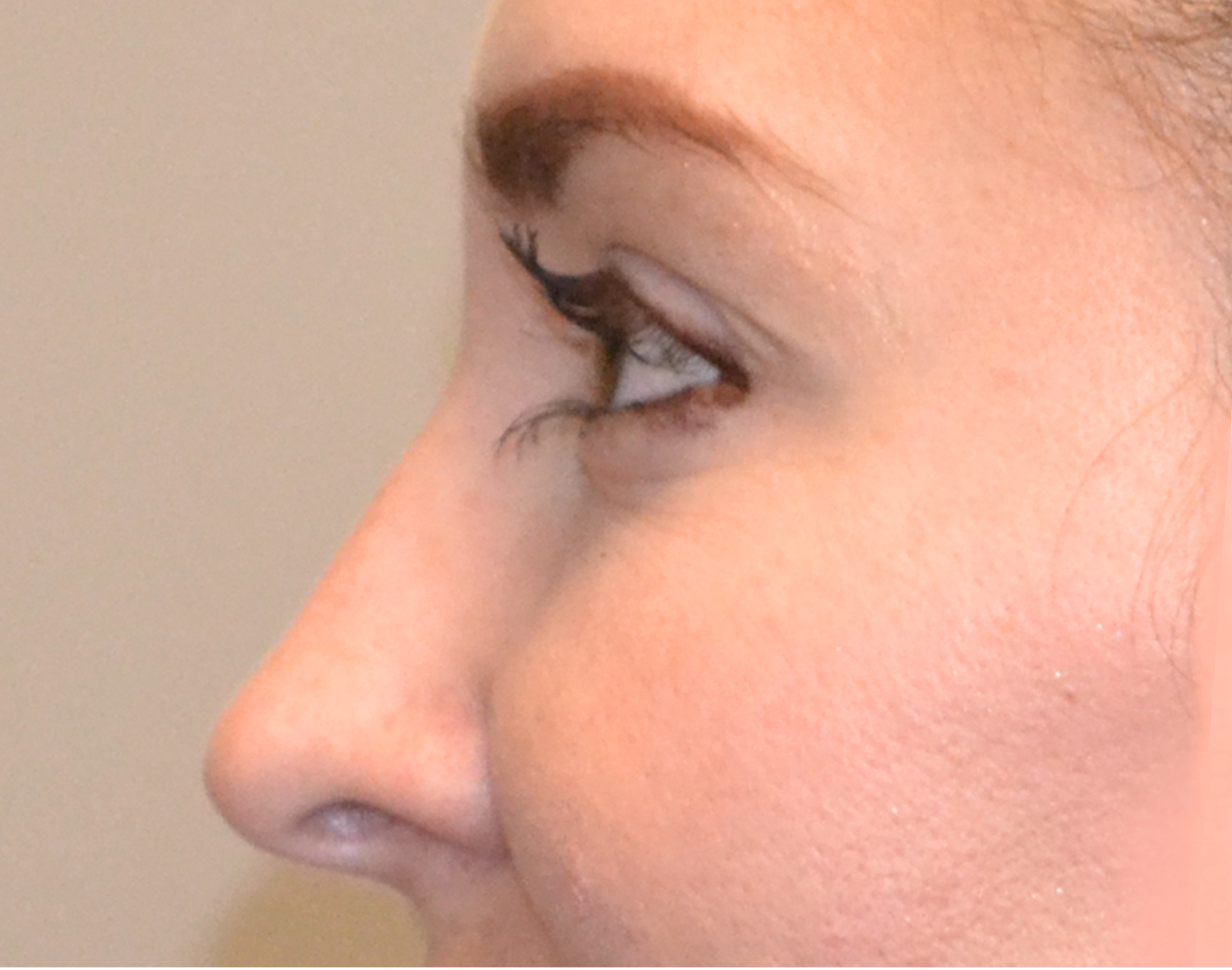 Eyelid Surgery (Blepharoplasty) Before & After Case 4