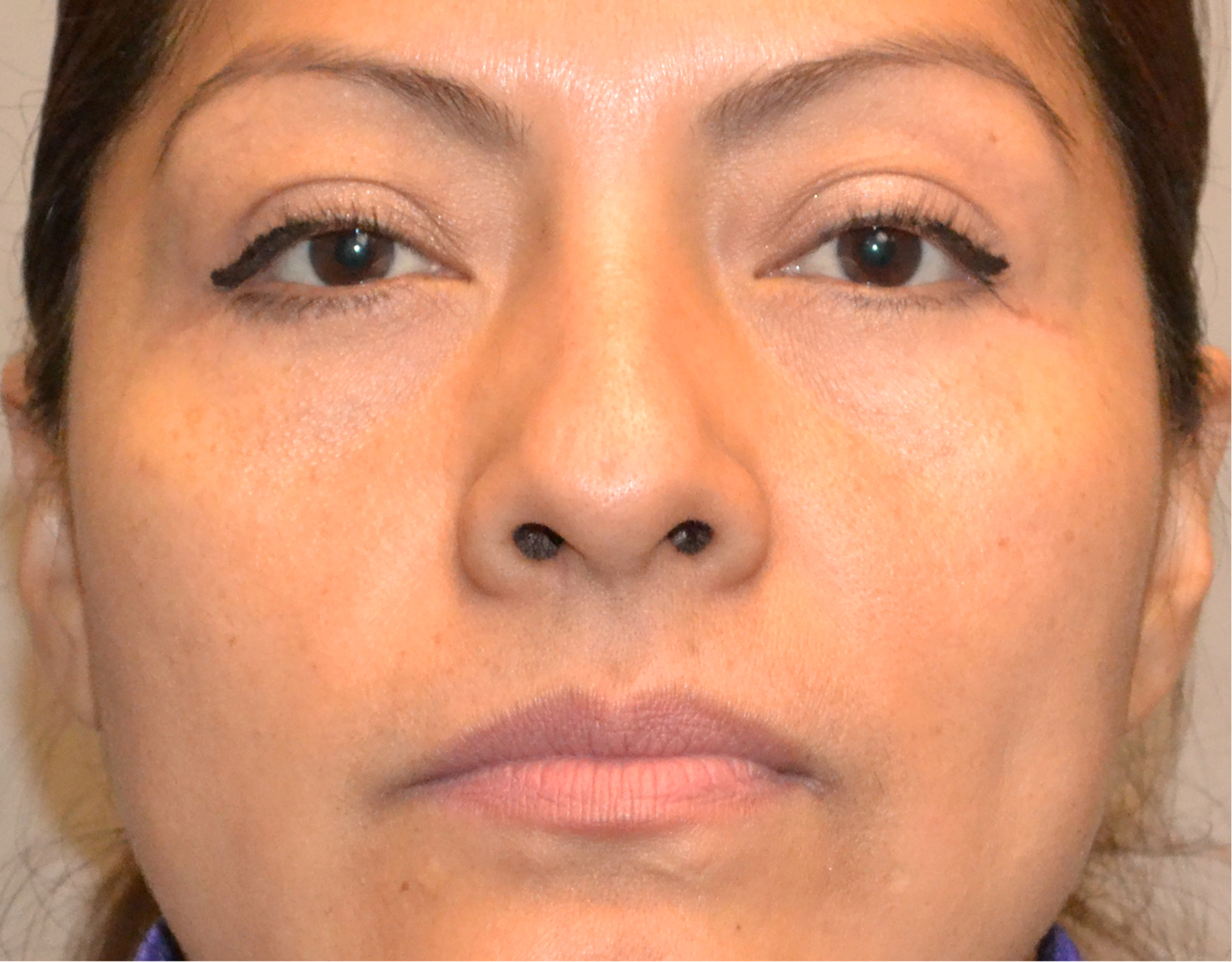 Eyelid Surgery (Blepharoplasty) Before & After Case 5