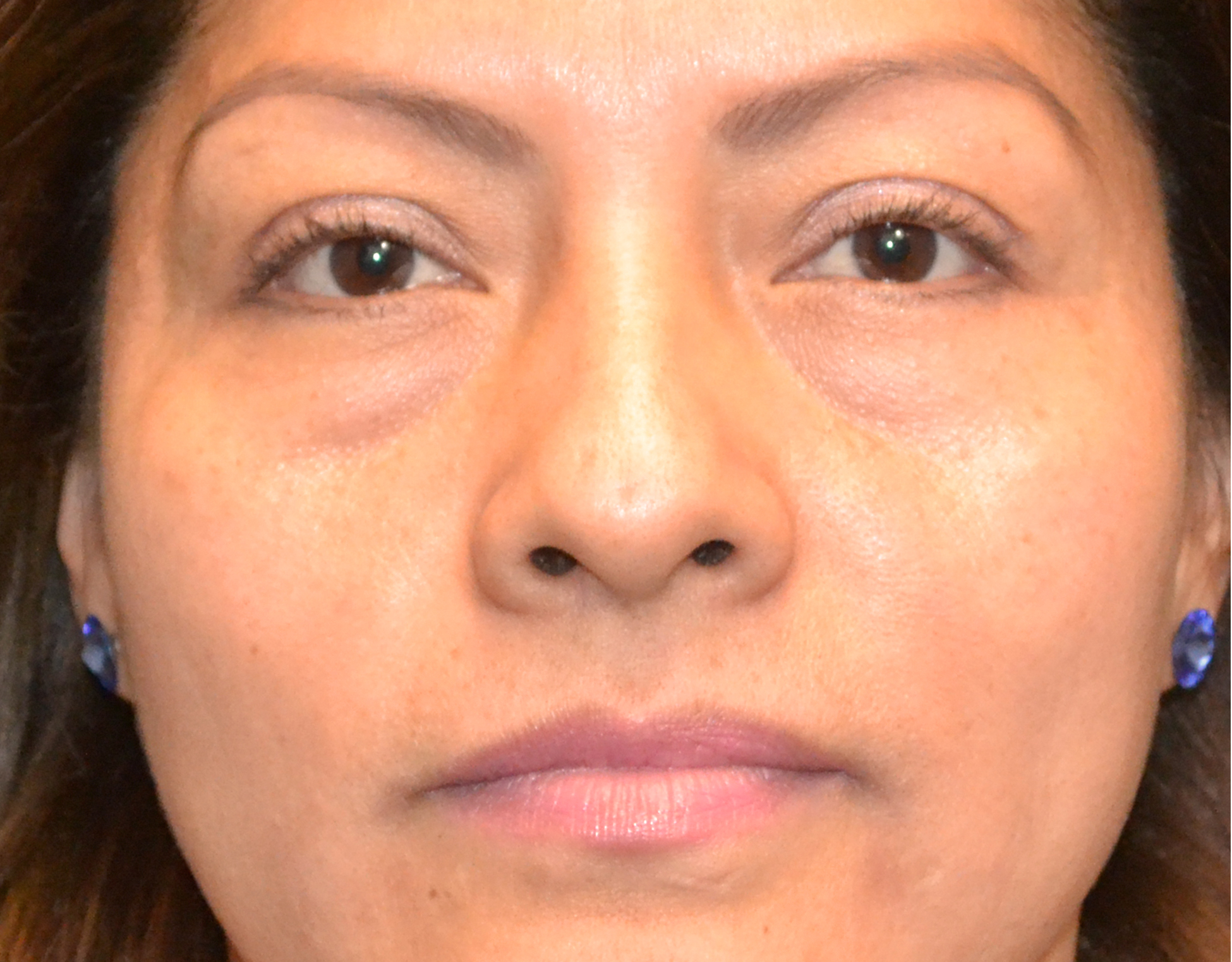 Eyelid Surgery (Blepharoplasty) Before & After Case 5