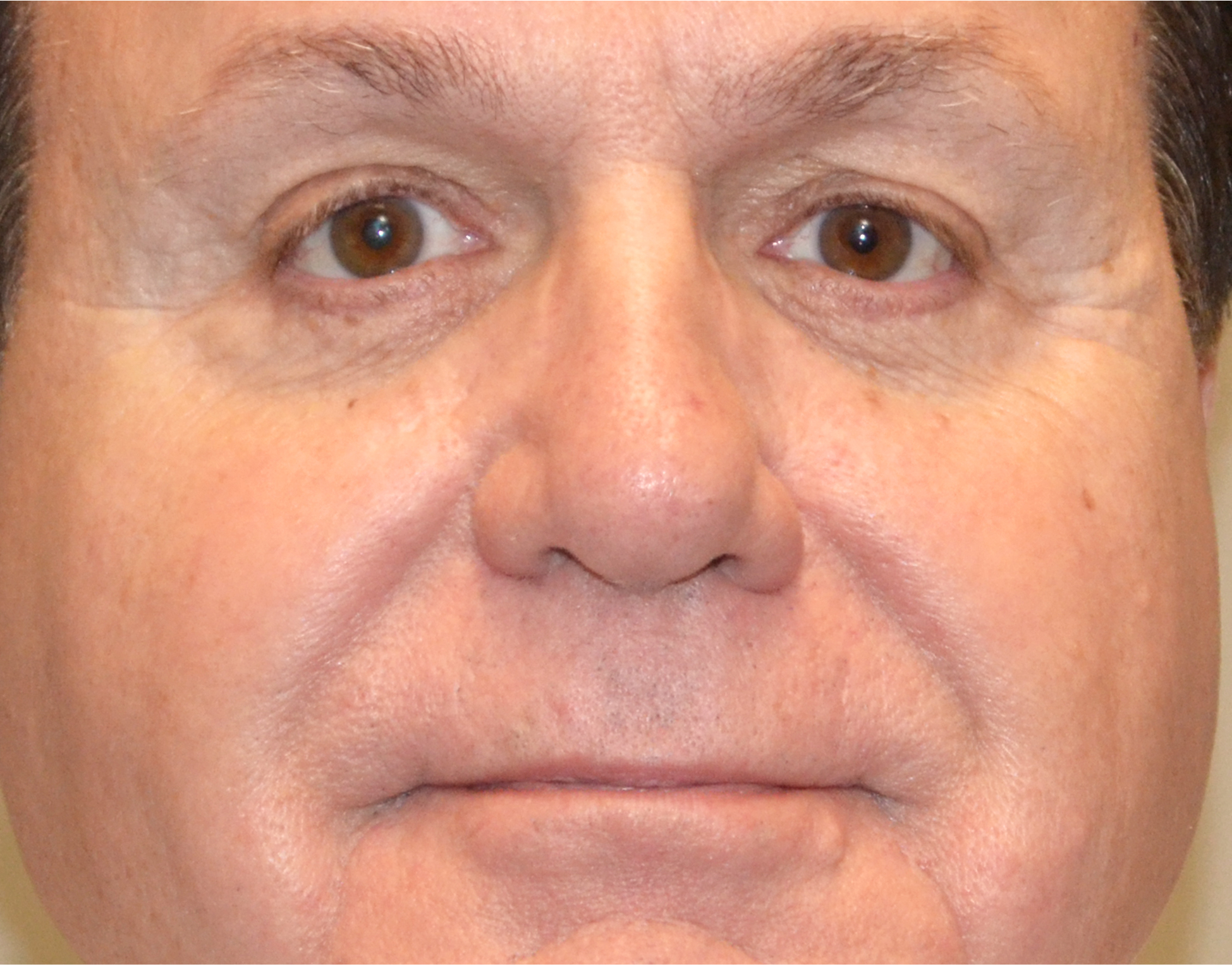 Eyelid Surgery (Blepharoplasty) Before & After Case 6