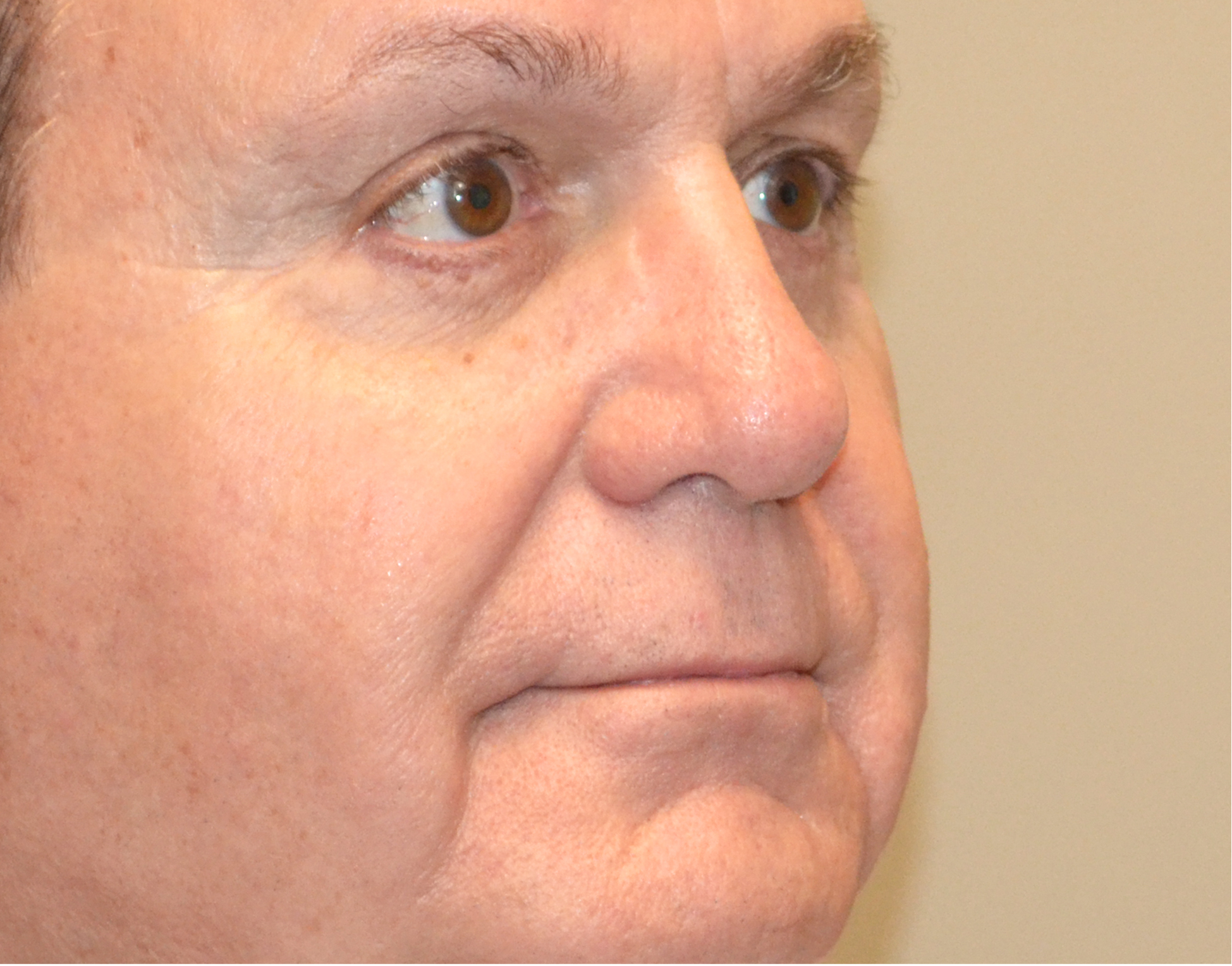 Eyelid Surgery (Blepharoplasty) Before & After Case 6